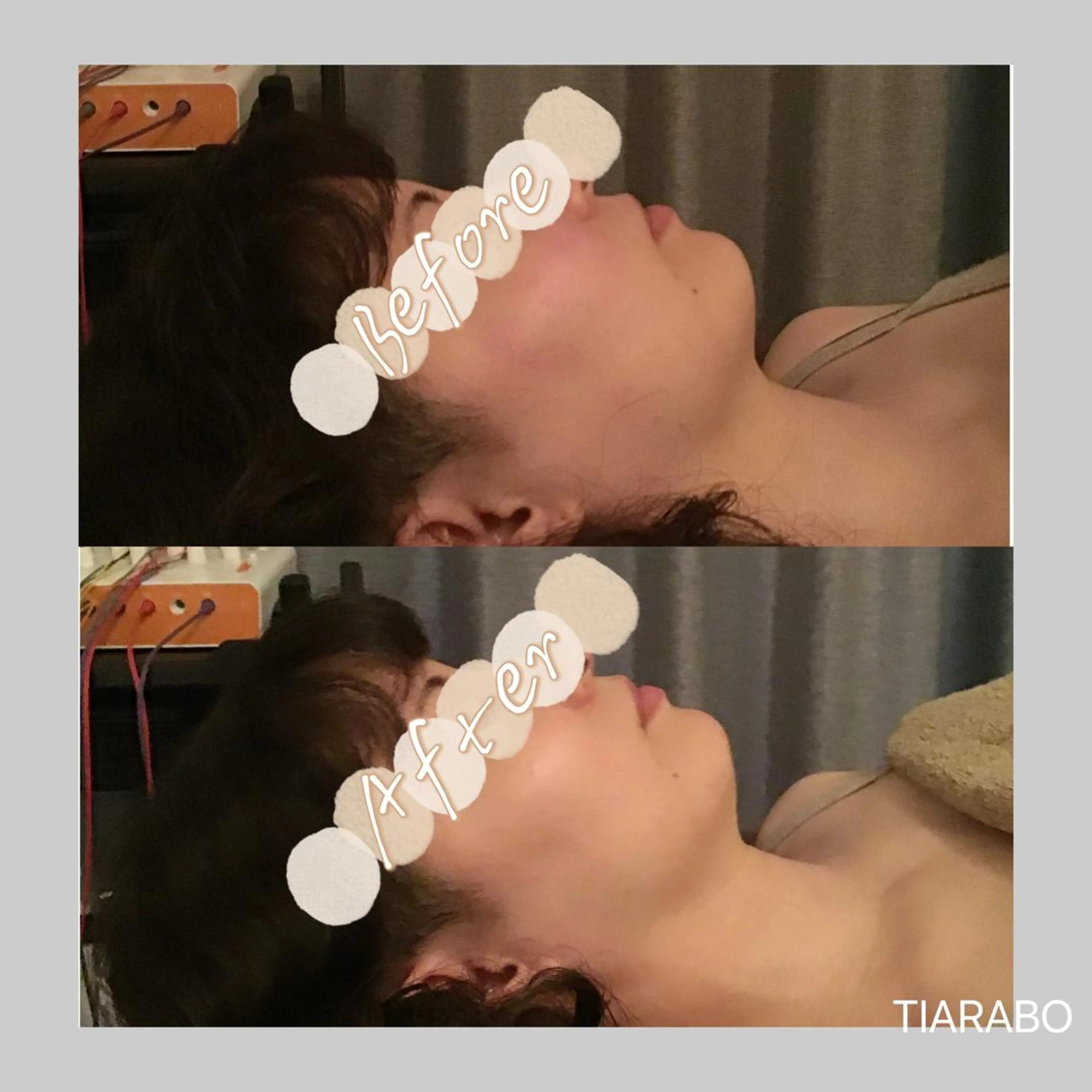 TIARABO 小顔美容鍼のエステ・リラクイメージ