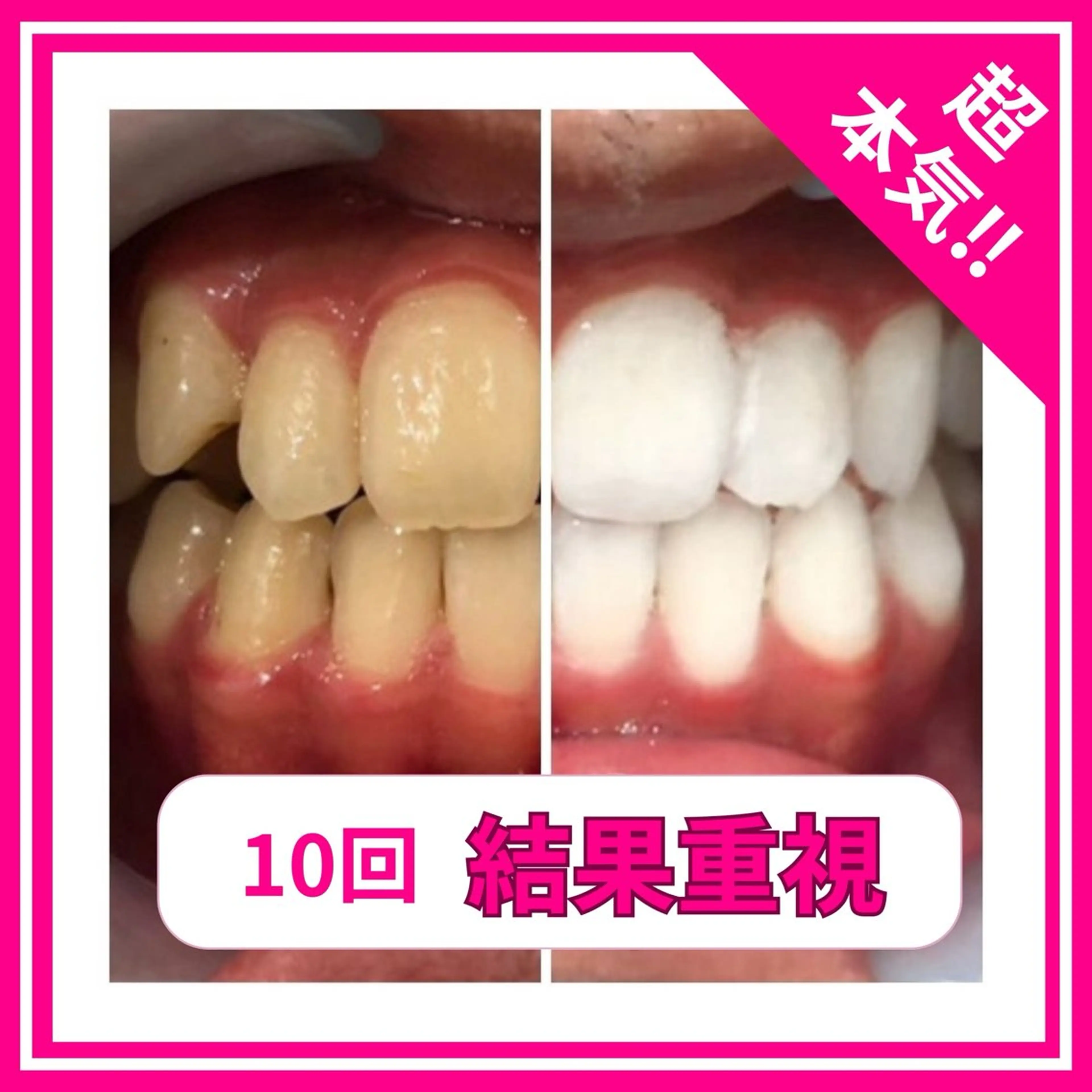 【圧倒的効果‼️】医療ホワイトニング回数券はこちらから💁‍♀️の写真