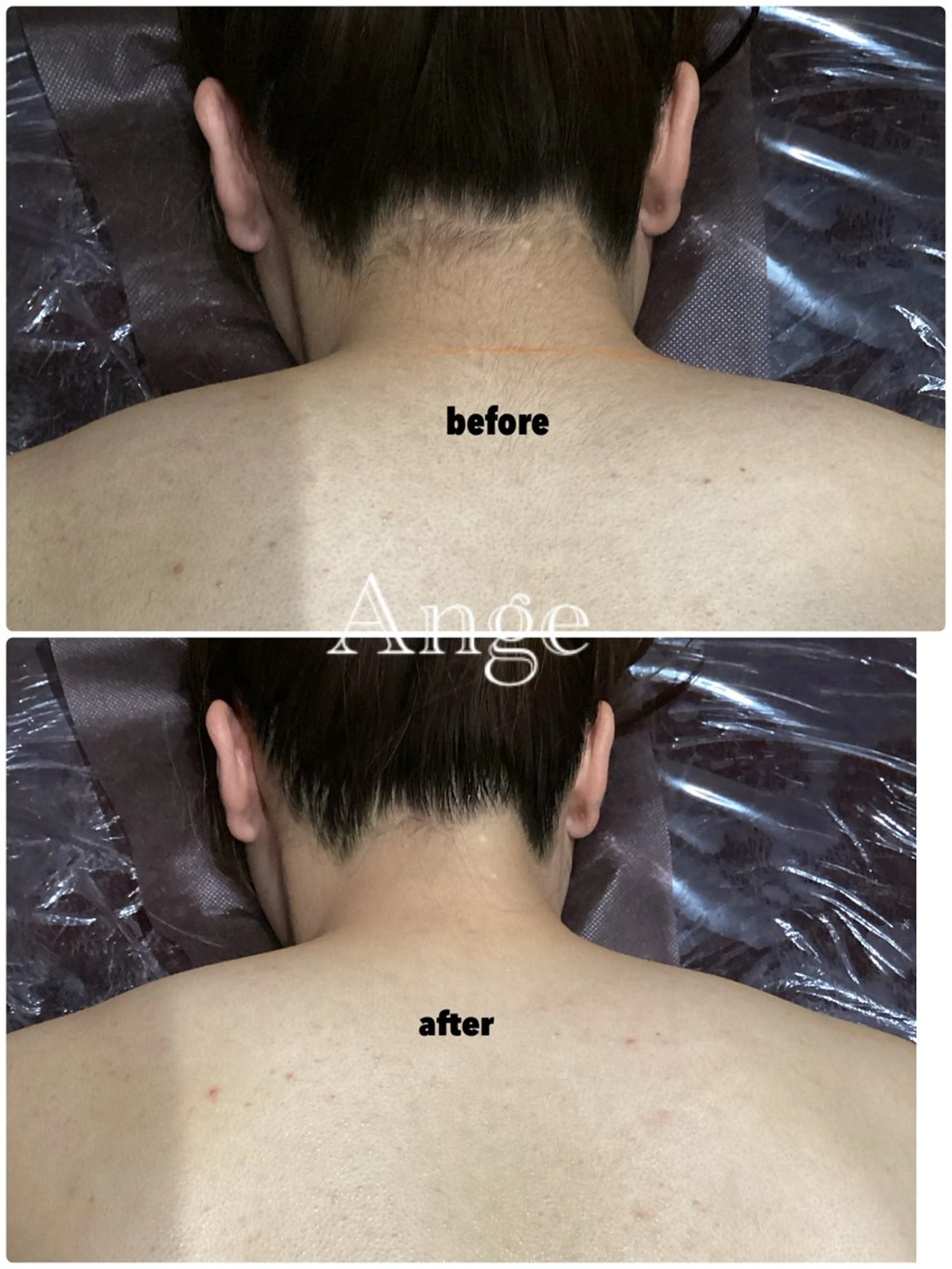 【うなじ＋背中＋腰】自分で処理できない！人から見られる！全箇所自己処理不要💁🏻‍♀️うなじの形もお任せください🫡の写真