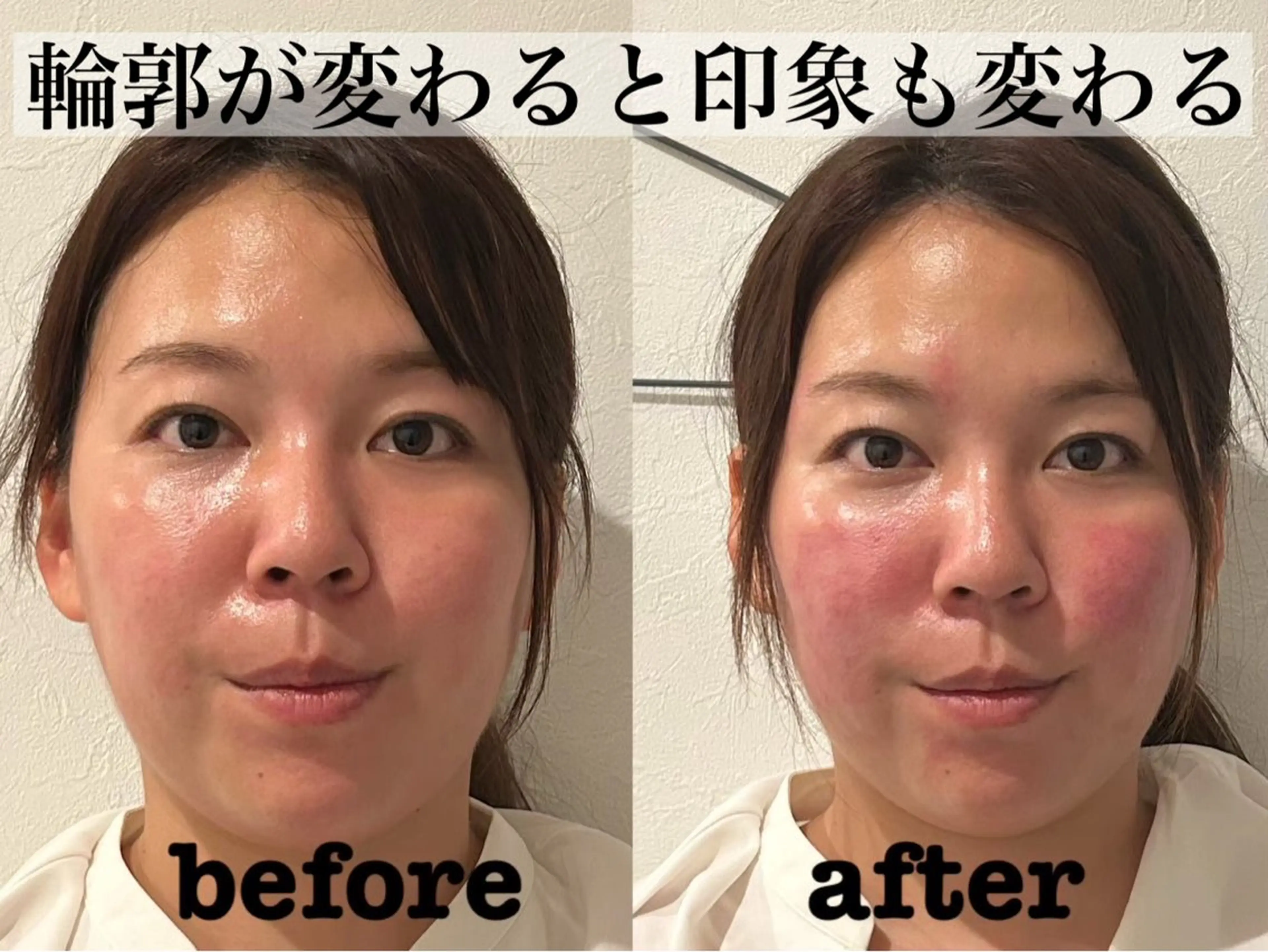エステ リラク 肌質改善×美容鍼 ゆいのエステ・リラクイメージ