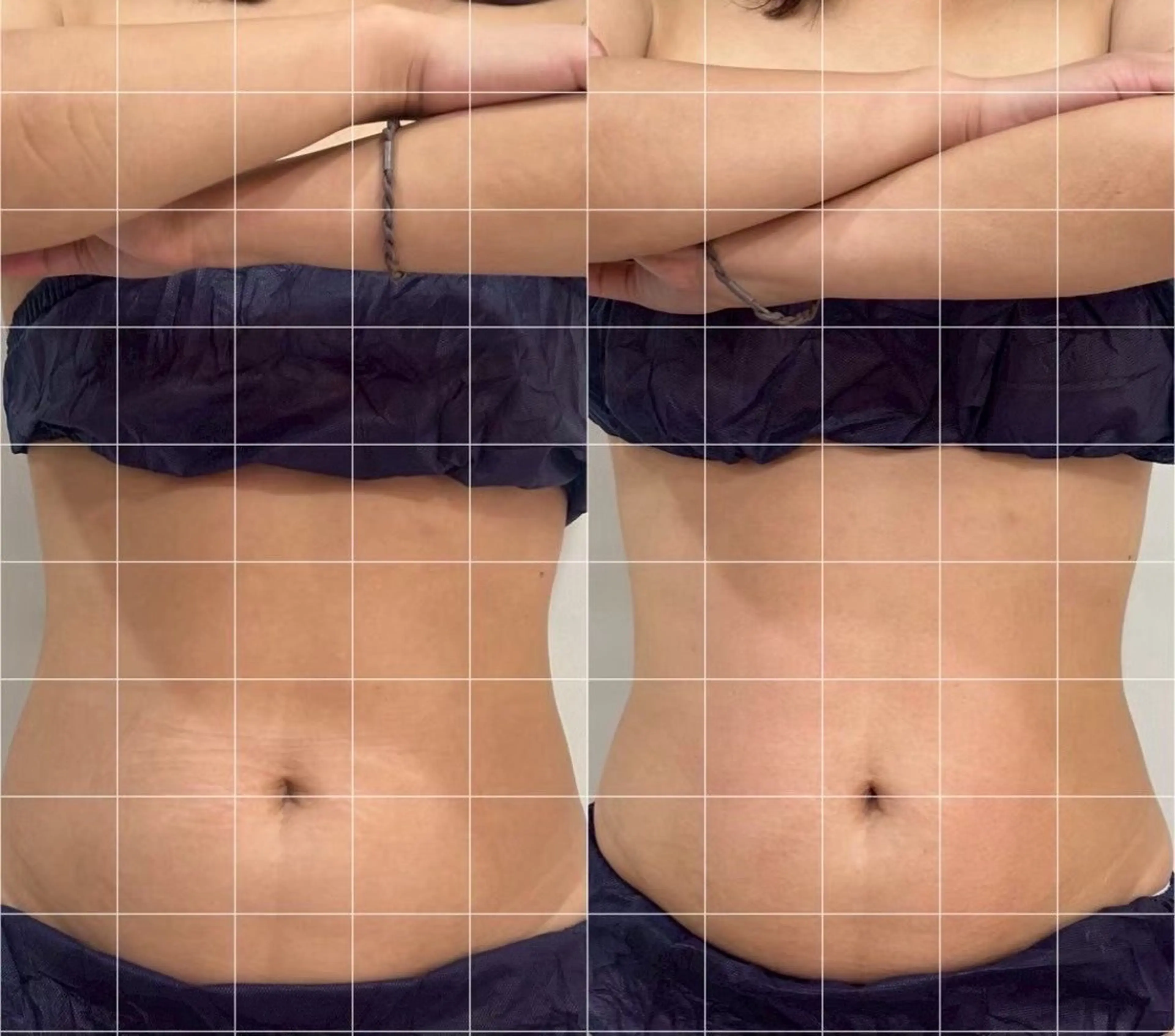 💎４月限定💎【痩身】ぽっこりお腹が気になる方に🔥の写真