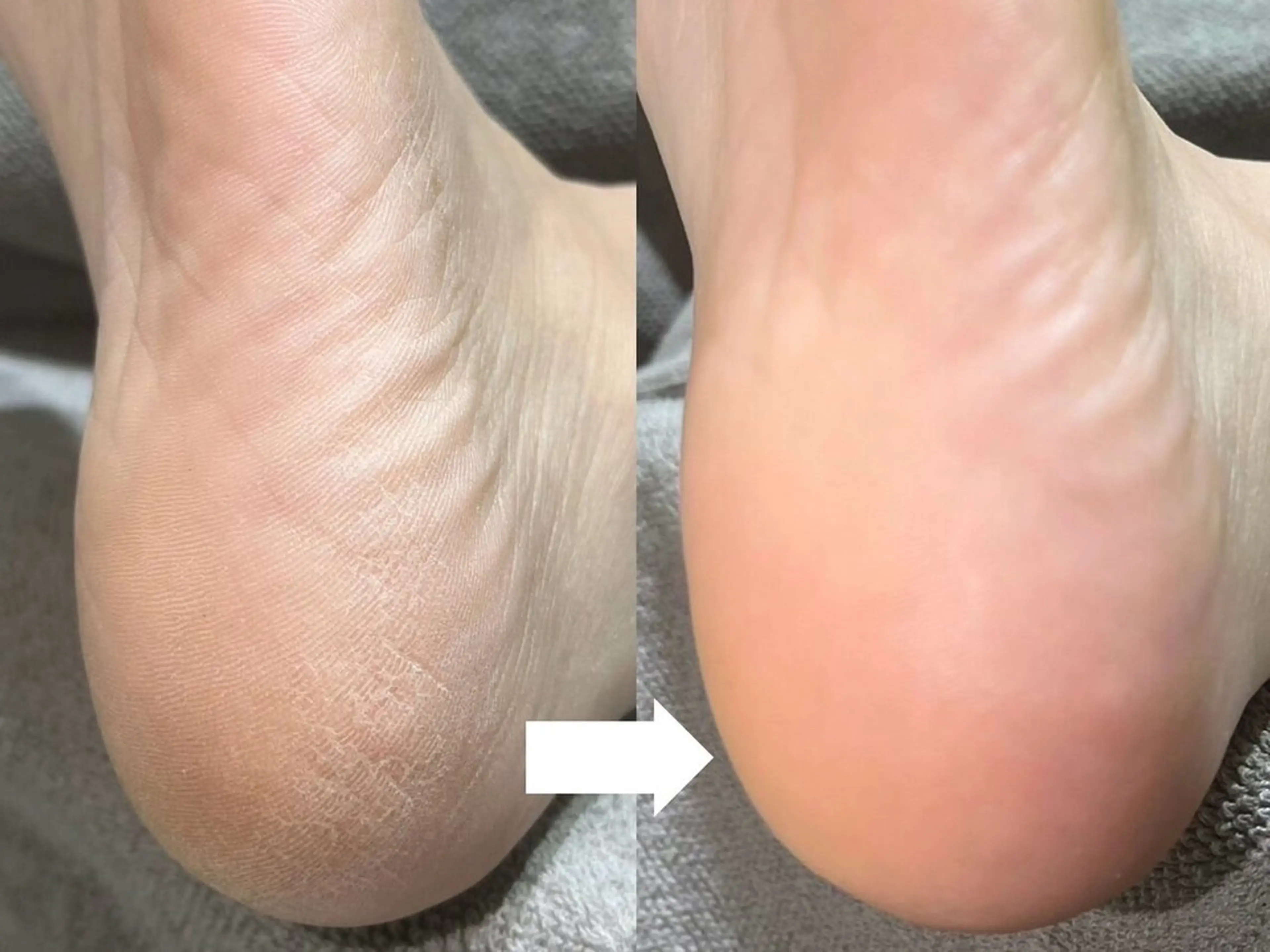 【フットケア】ガサガサかかとに◆フットスパ¥3500  ※角質除去のみ¥2200の写真