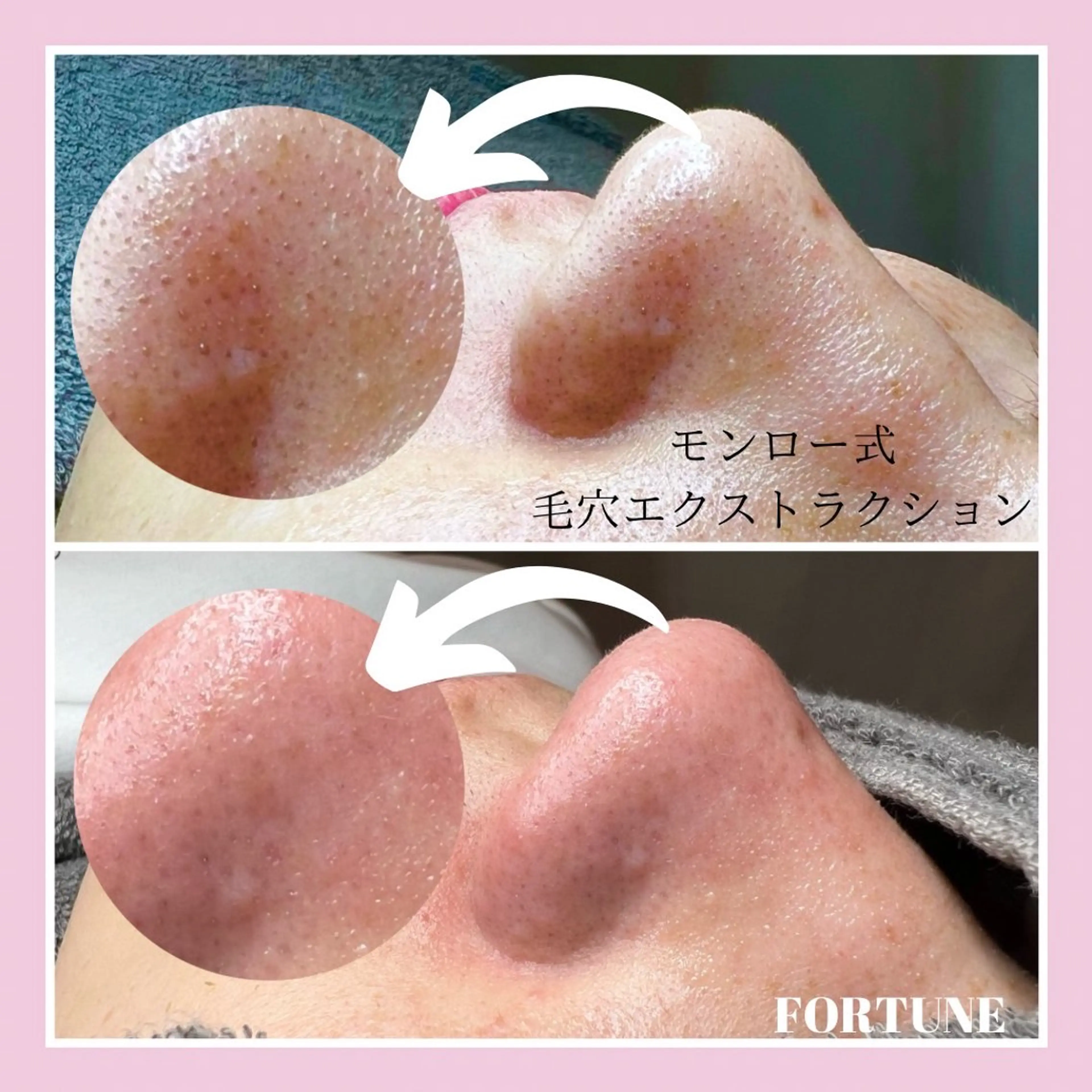 minimo特別価格✨小鼻の黒ずみ撃退!!モンロー式毛穴エクストラクションの写真