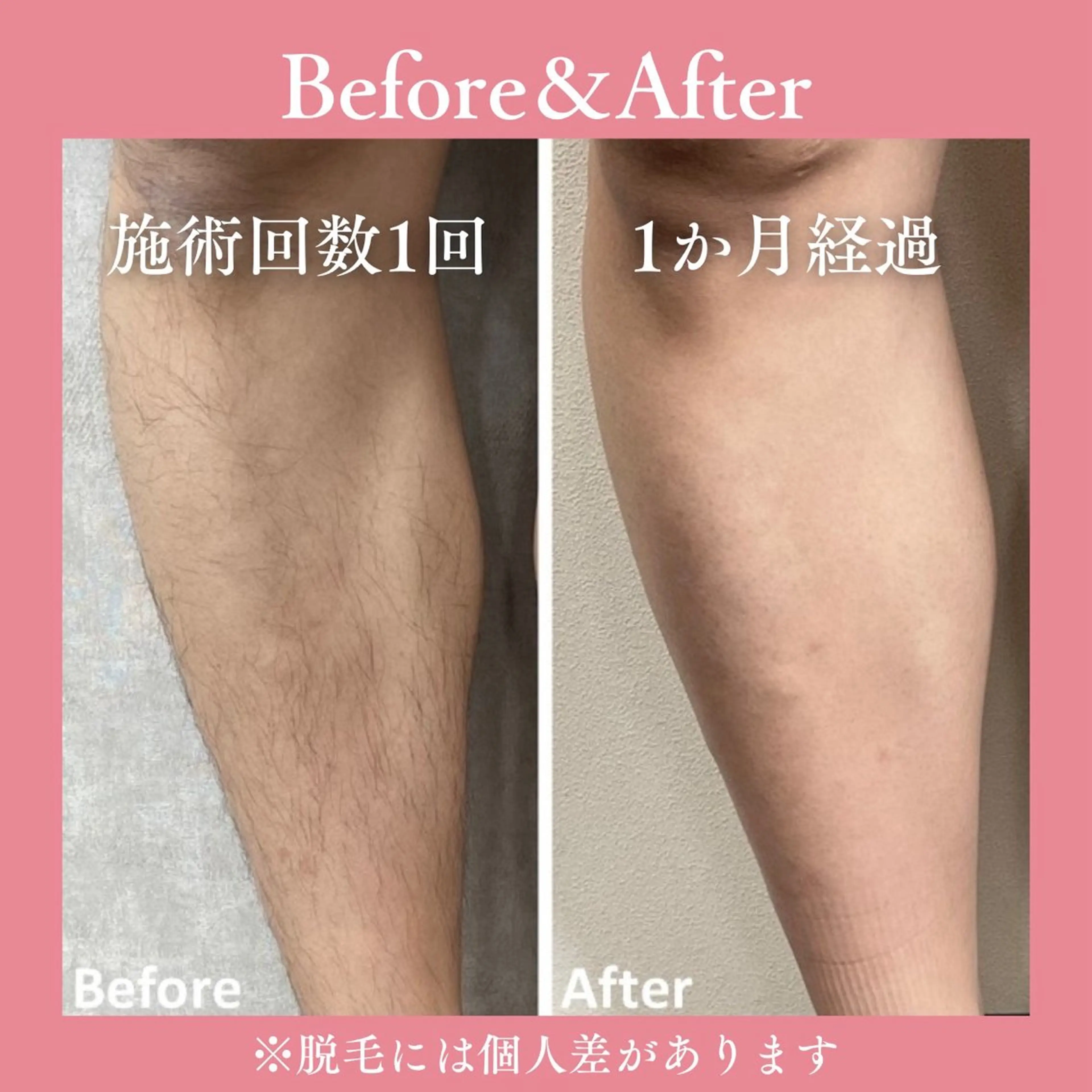 【男女】全身脱毛OK！セルフ脱毛30分★自信溢れるツルスベ肌を手に入れる！の写真