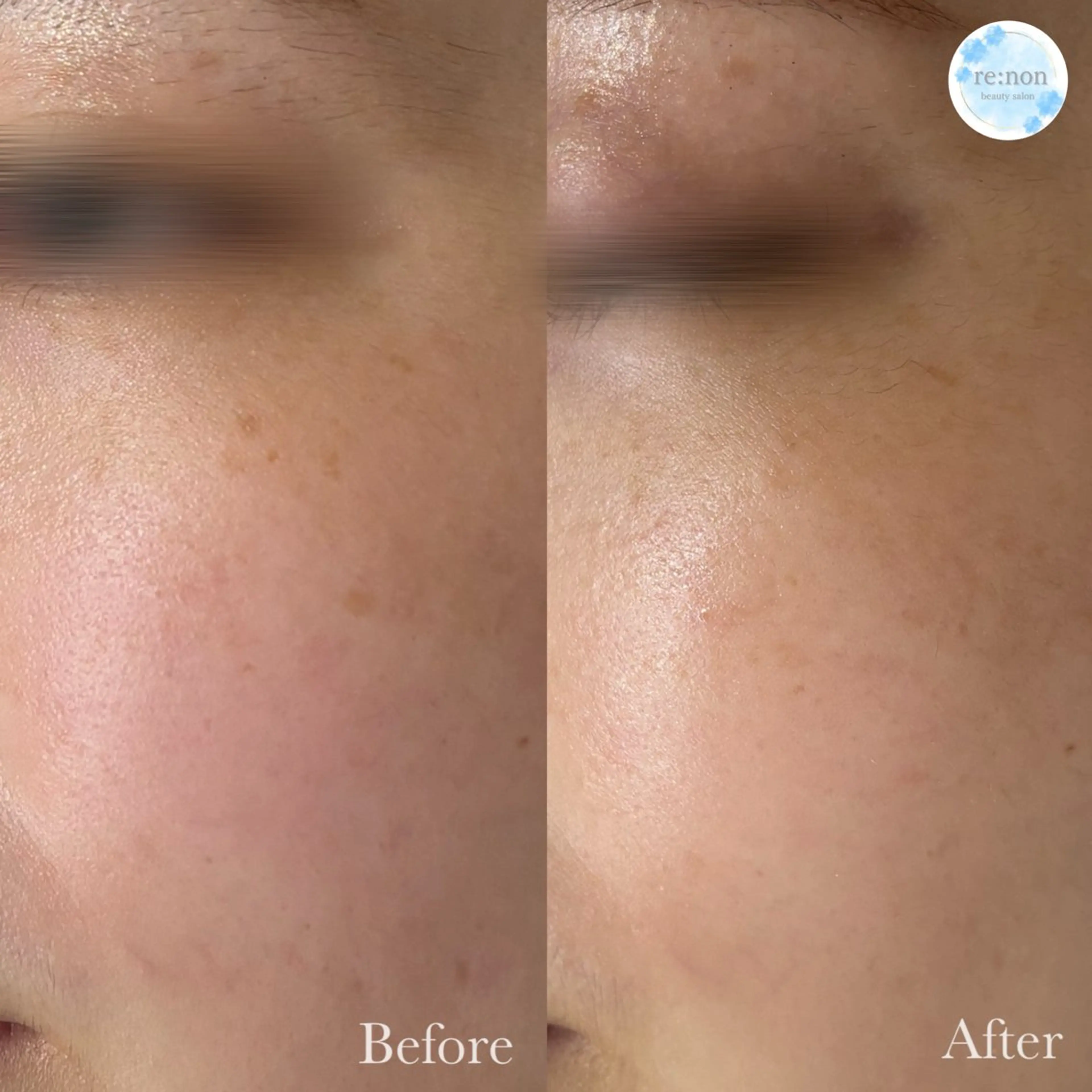 美容鍼脱毛salon リノン吹田駅前店のエステ・リラクイメージ