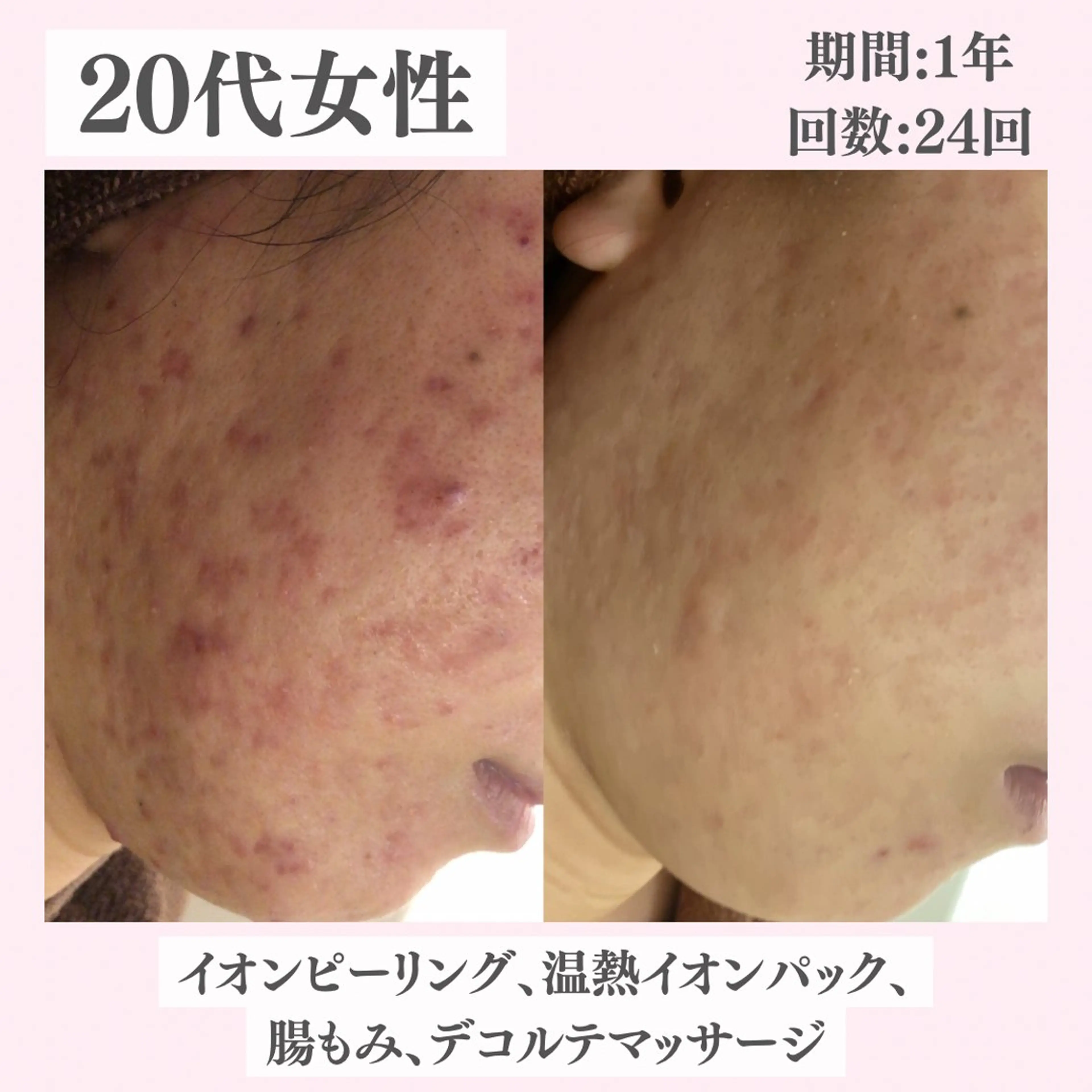 エステ リラク ニキビ・肌質改善専門 ♡人生が変わるサロンのエステ・リラクイメージ