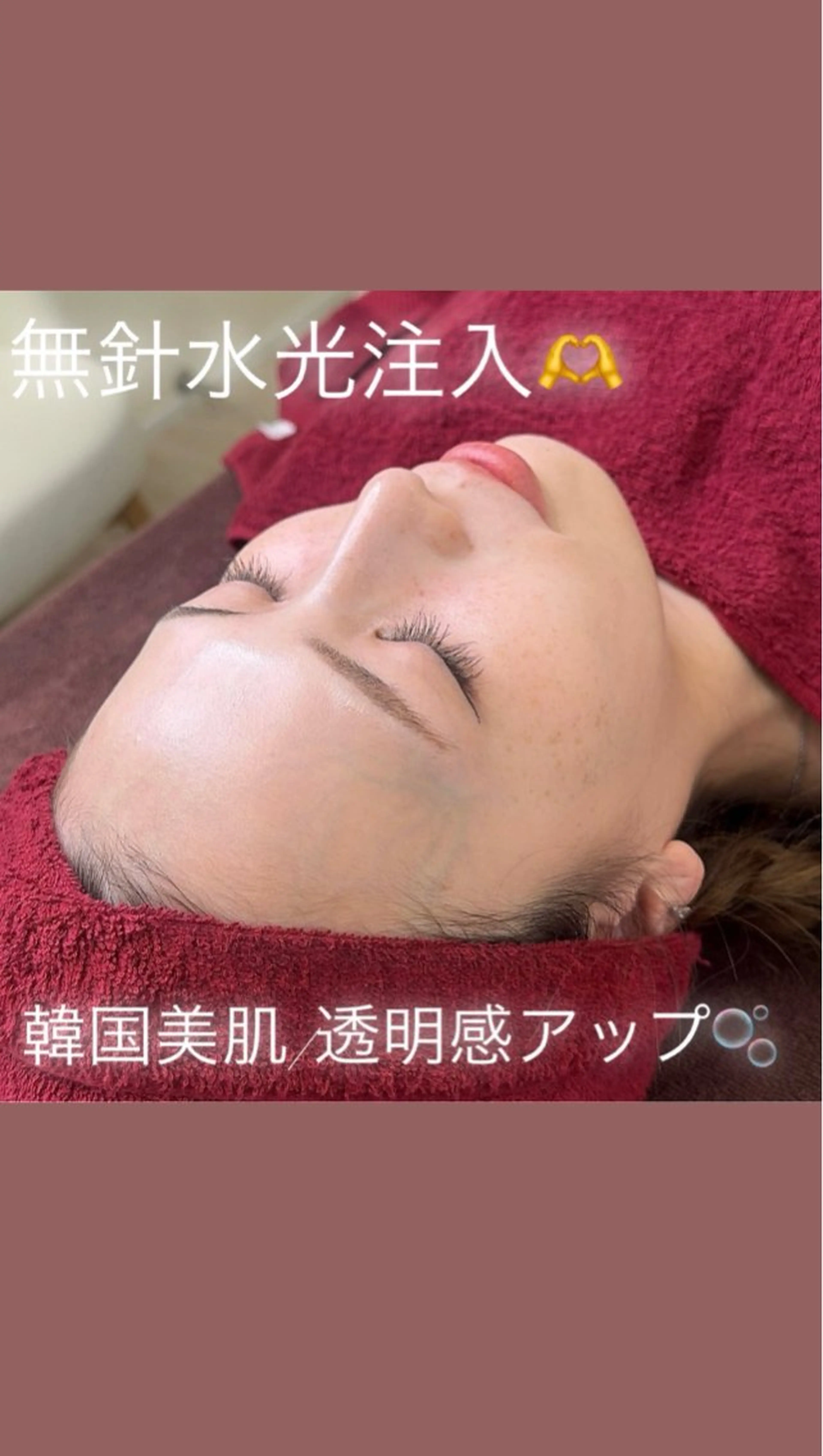 【シミ・くすみ】高濃度酸素注入+100%美容液導入でツヤ肌へ♪の写真