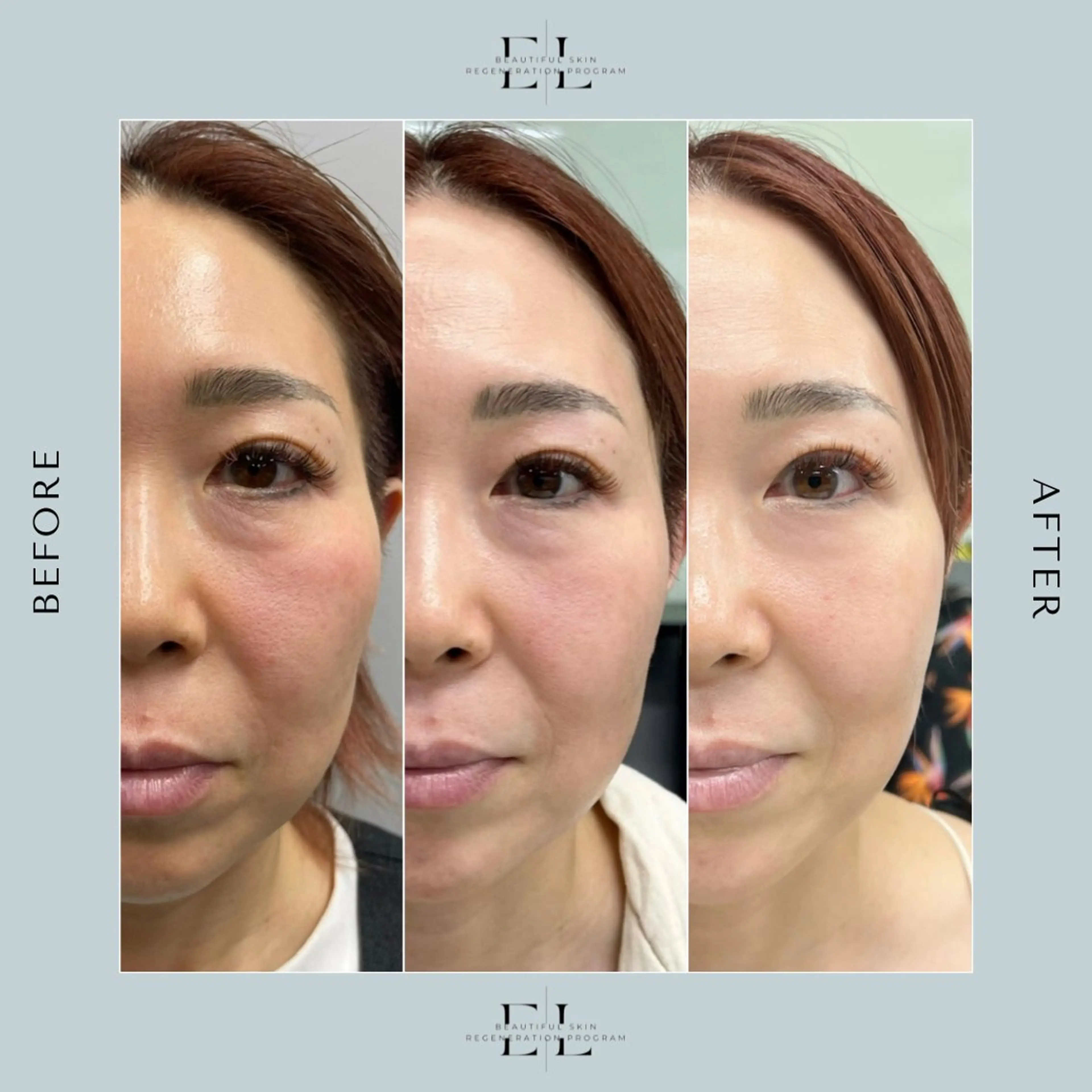 ExoLift エクソリフト【自己再生能力を最大限に引き出す肌改善プログラム】の写真