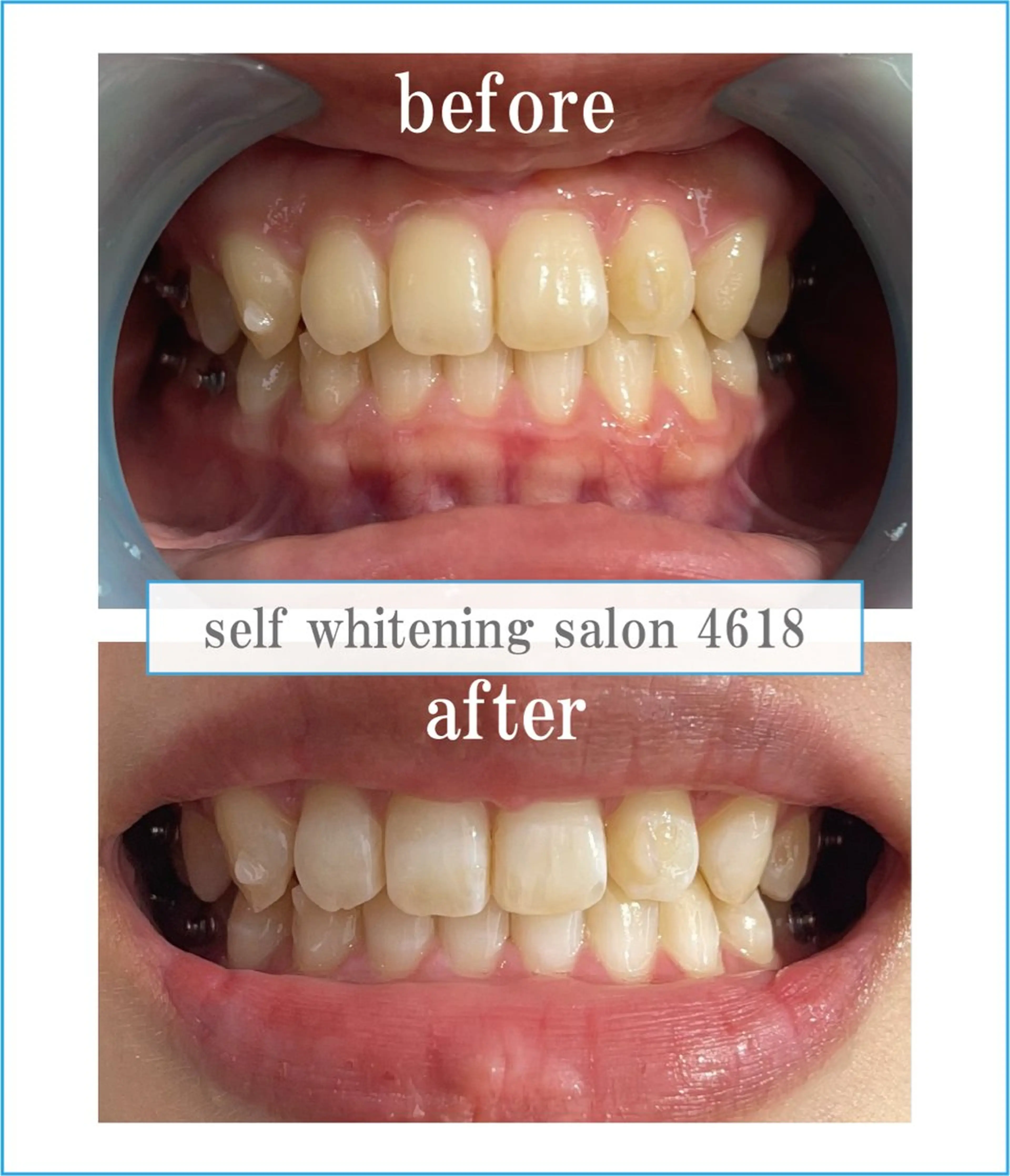 その他 self whitening salon 4618所属・ホワイトニングサロン 4618のその他イメージ