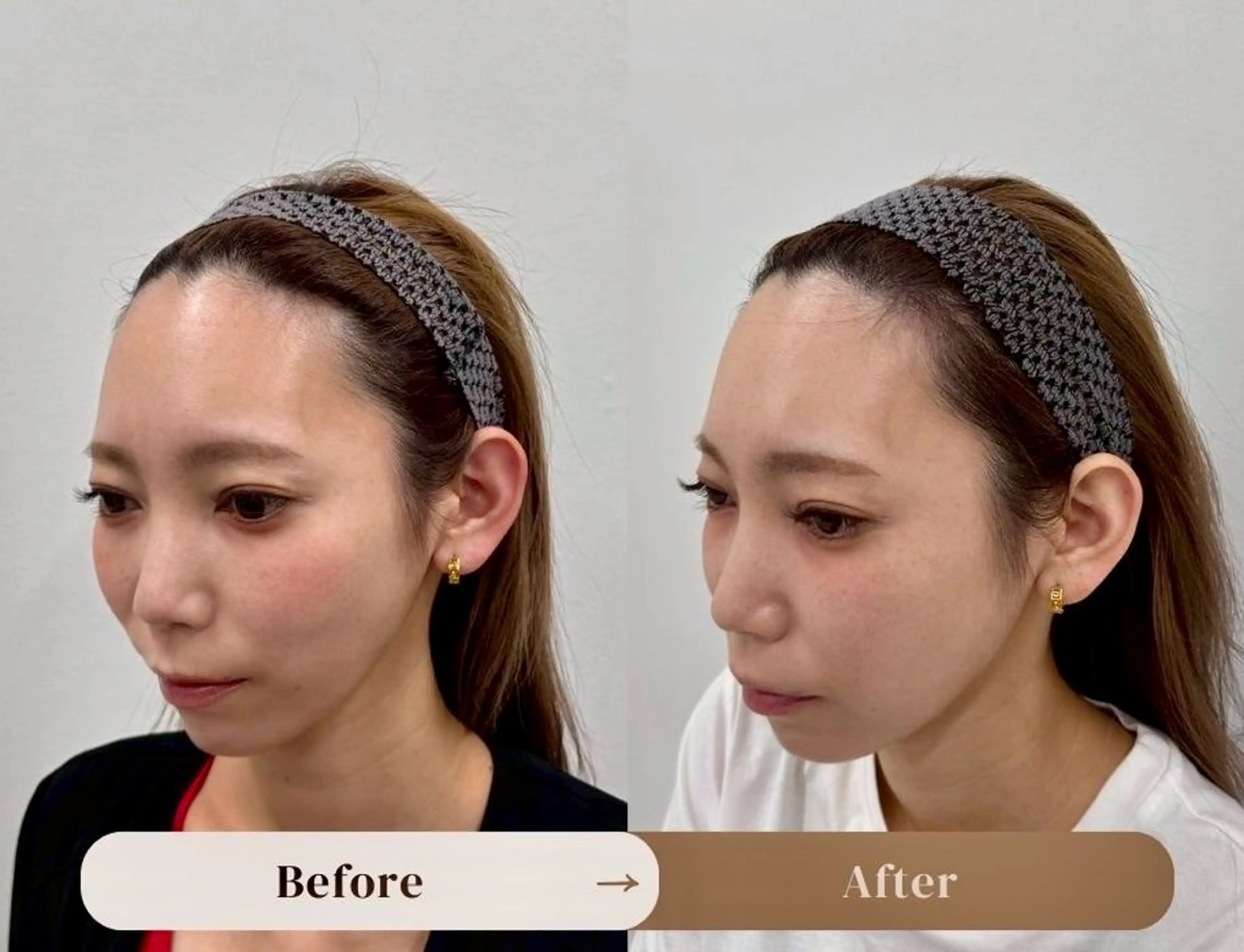 フェイスラインのお悩み解消ヘアタトゥー（SMP）の写真