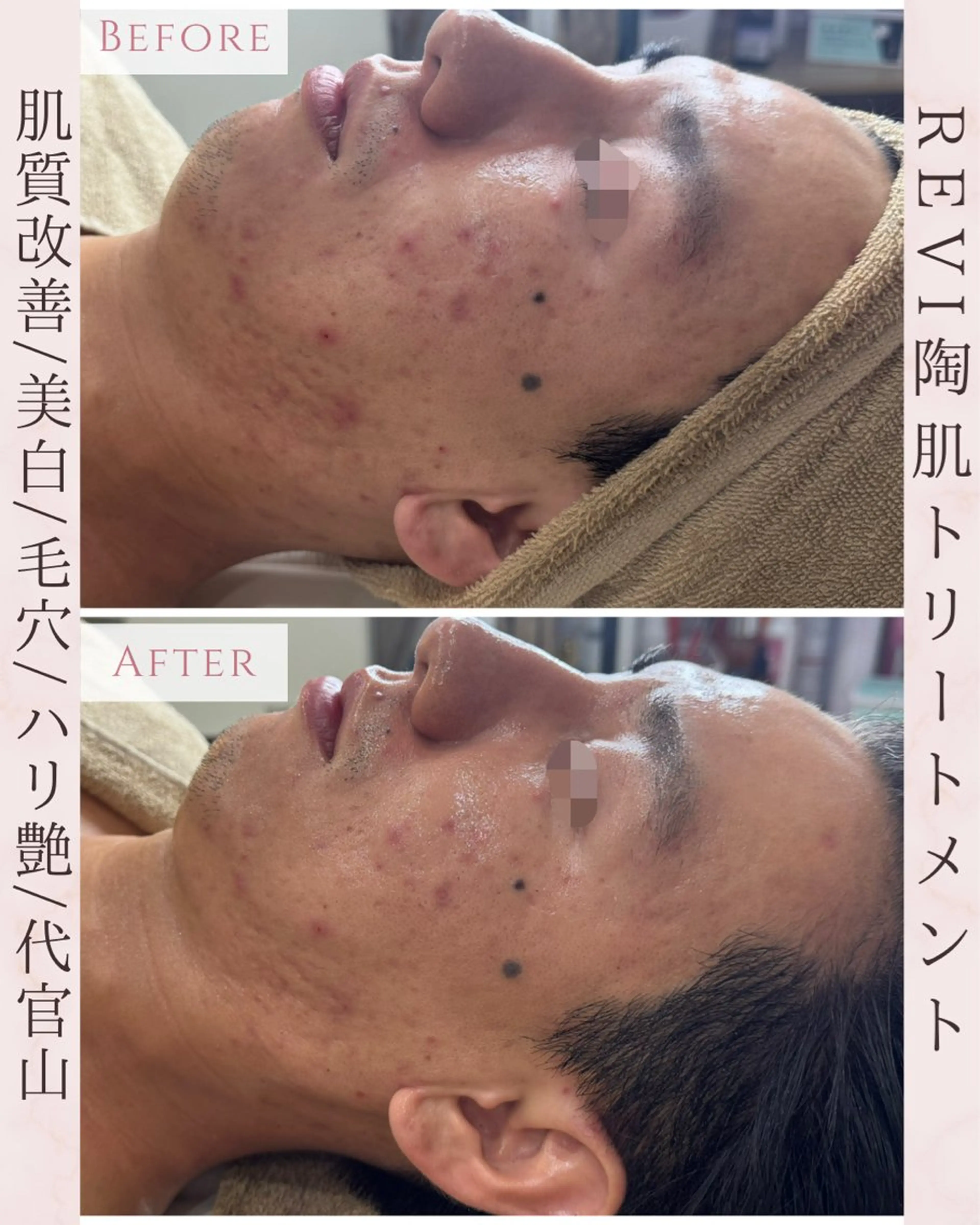 エステ 【ハーブピーリング/韓国ツヤ肌ピーリング】RelierBelle-ルリエベル-所属・肌質改善/肌育特化 プライベートサロンのエステ・リラクイメージ