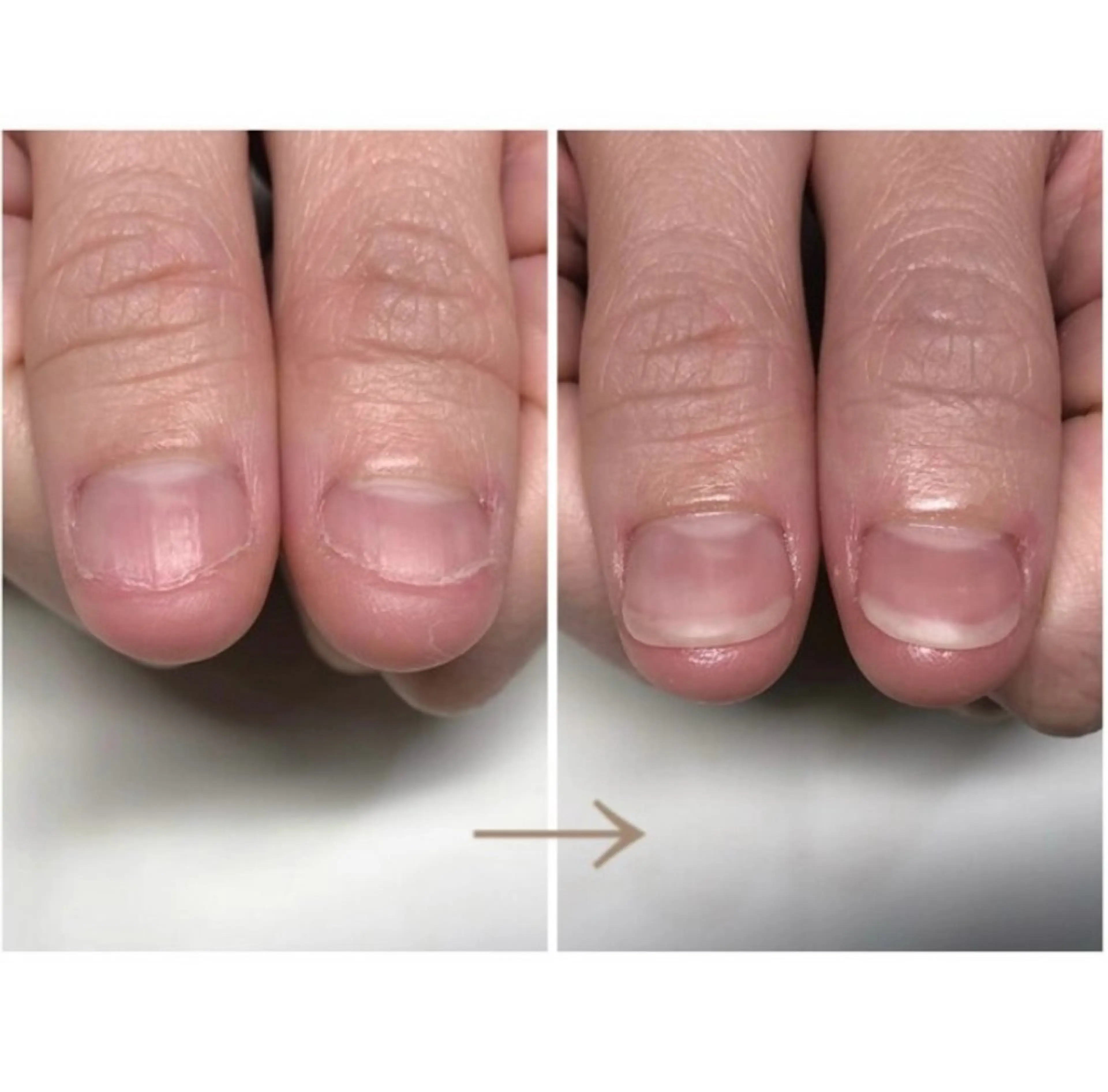 ネイル 深爪矯正・自爪育成 ヴェールリムのネイルデザイン