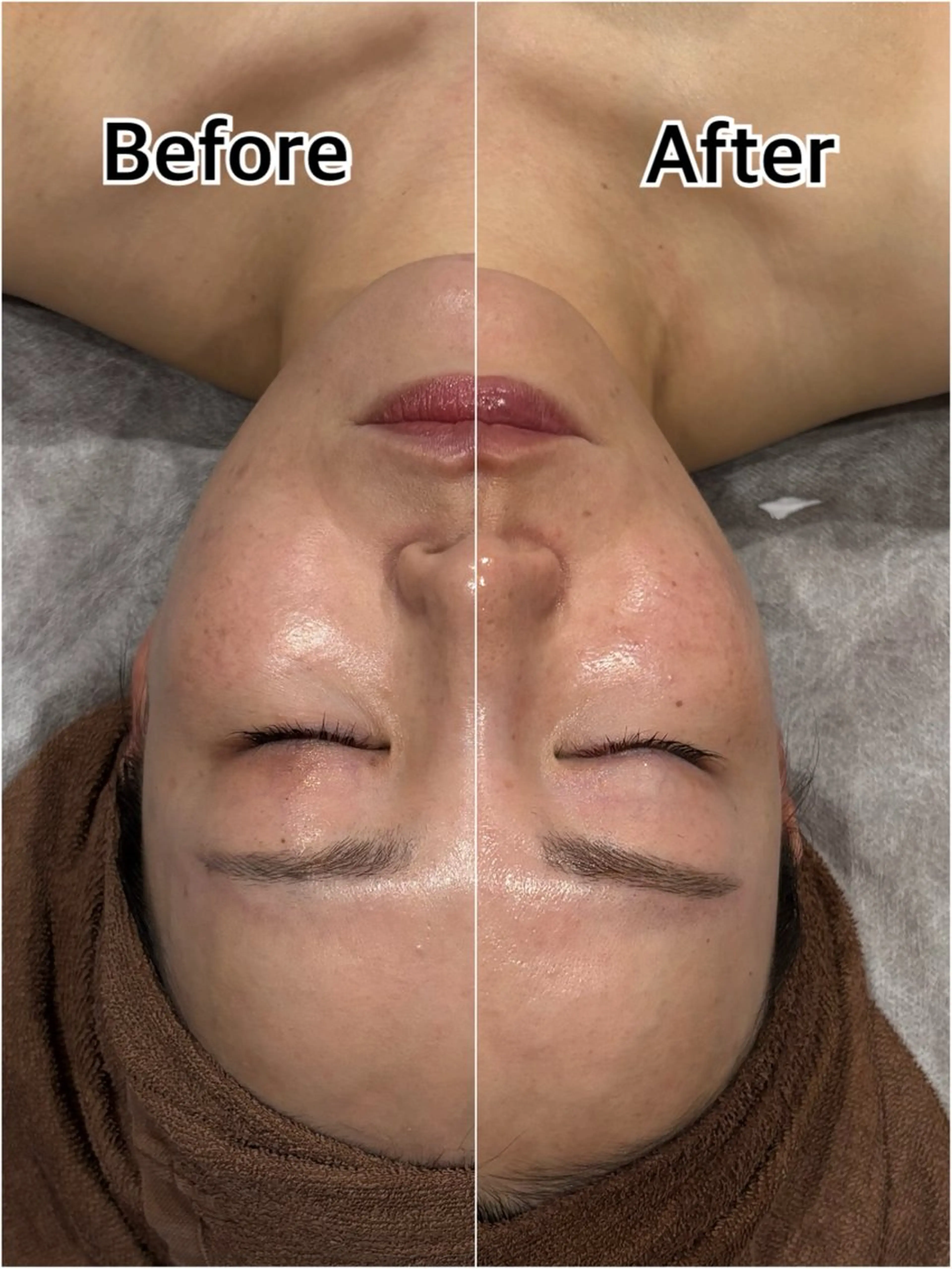 【小顔も透明感も】炭酸ガスケア込リフトアップフェイシャル＋美容成分導入の写真