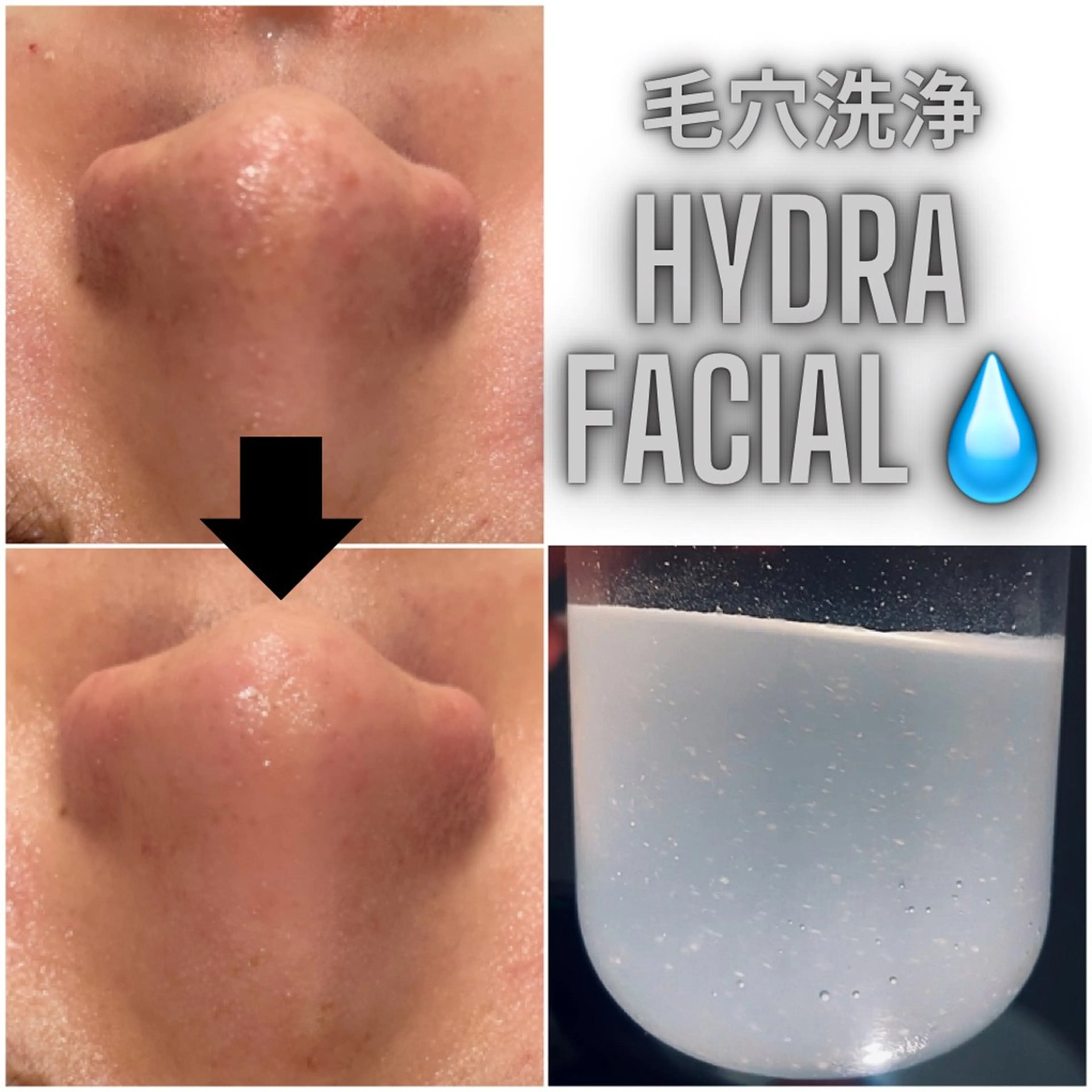 先着10名様限定!ハイドラ毛穴洗浄💧1ヶ月分スキンケアセット福袋付き¥6600🉐の写真