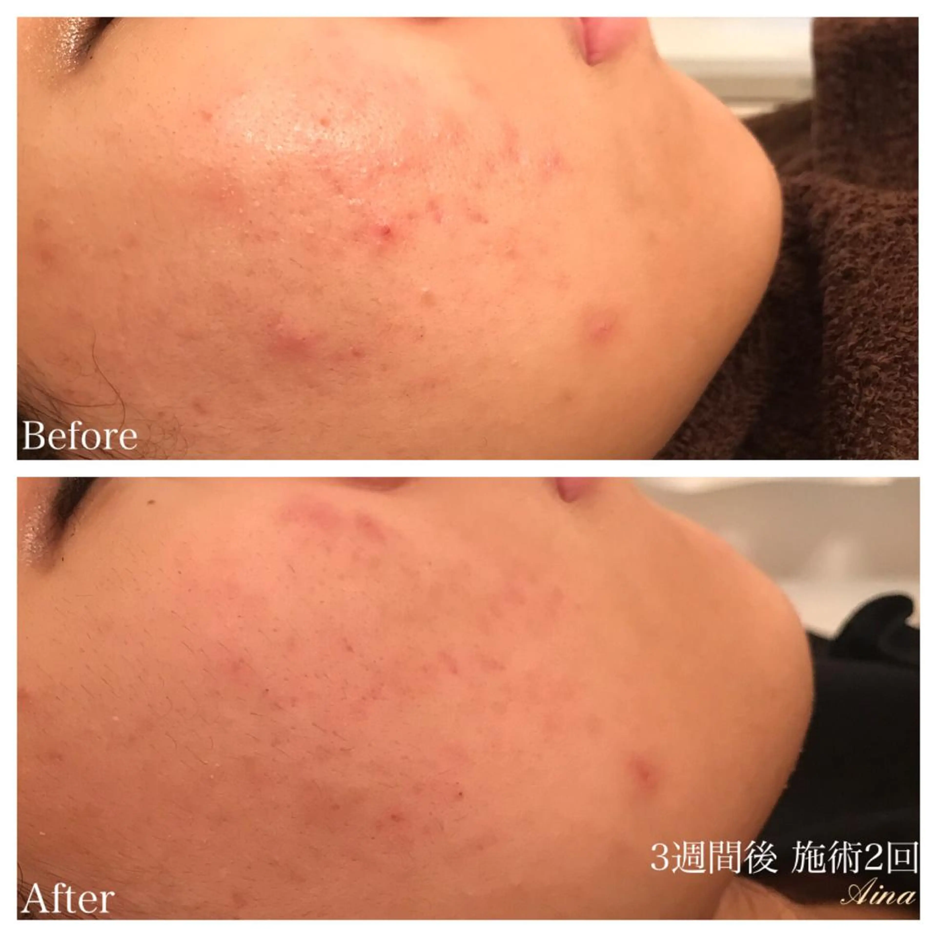 ロング ネイル マツエク・マツパ ニキビ跡専門サロン Ａｉｎａのエステ・リラクイメージ