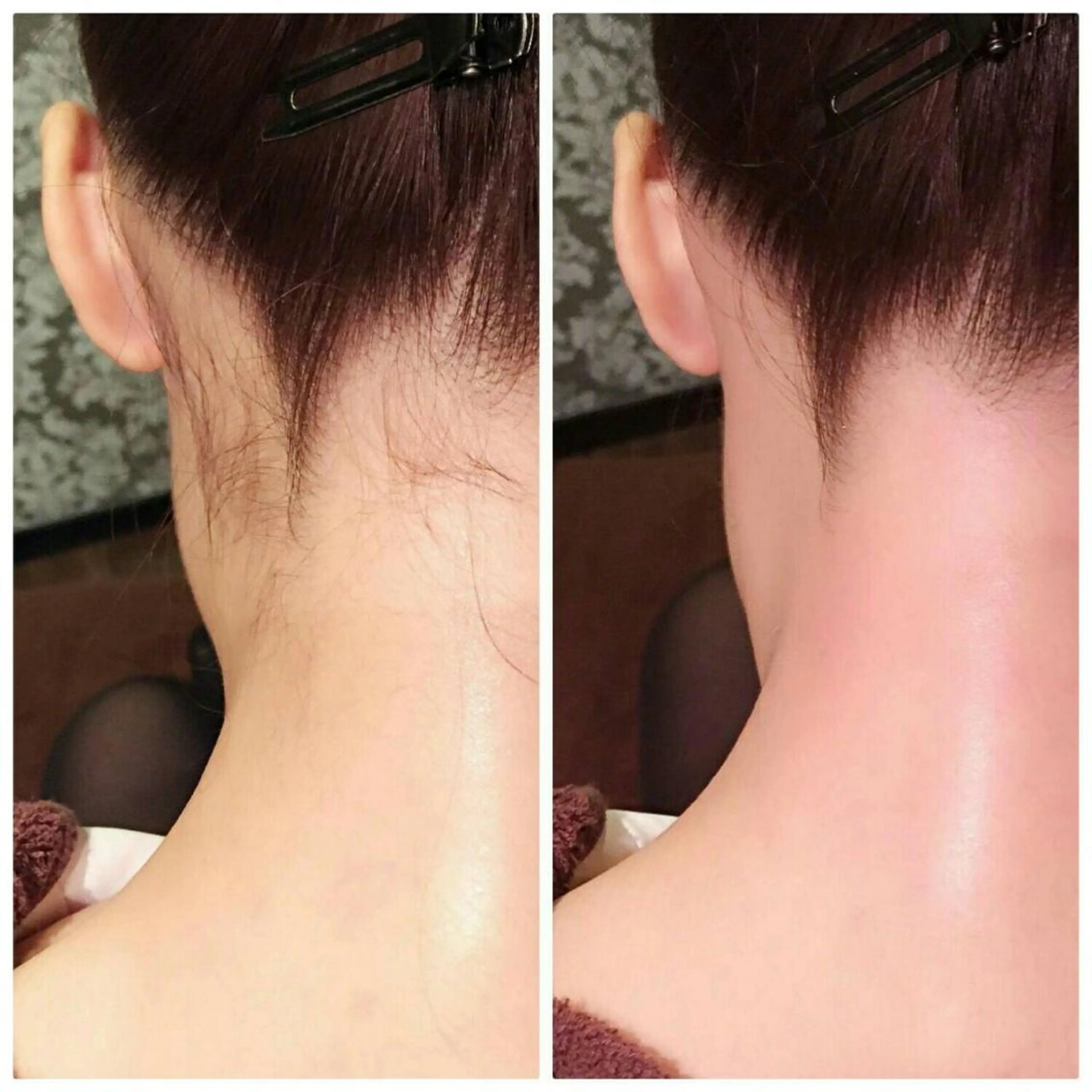 ブライダルシェービング（脱毛、挙式やイベント前に◎）の写真