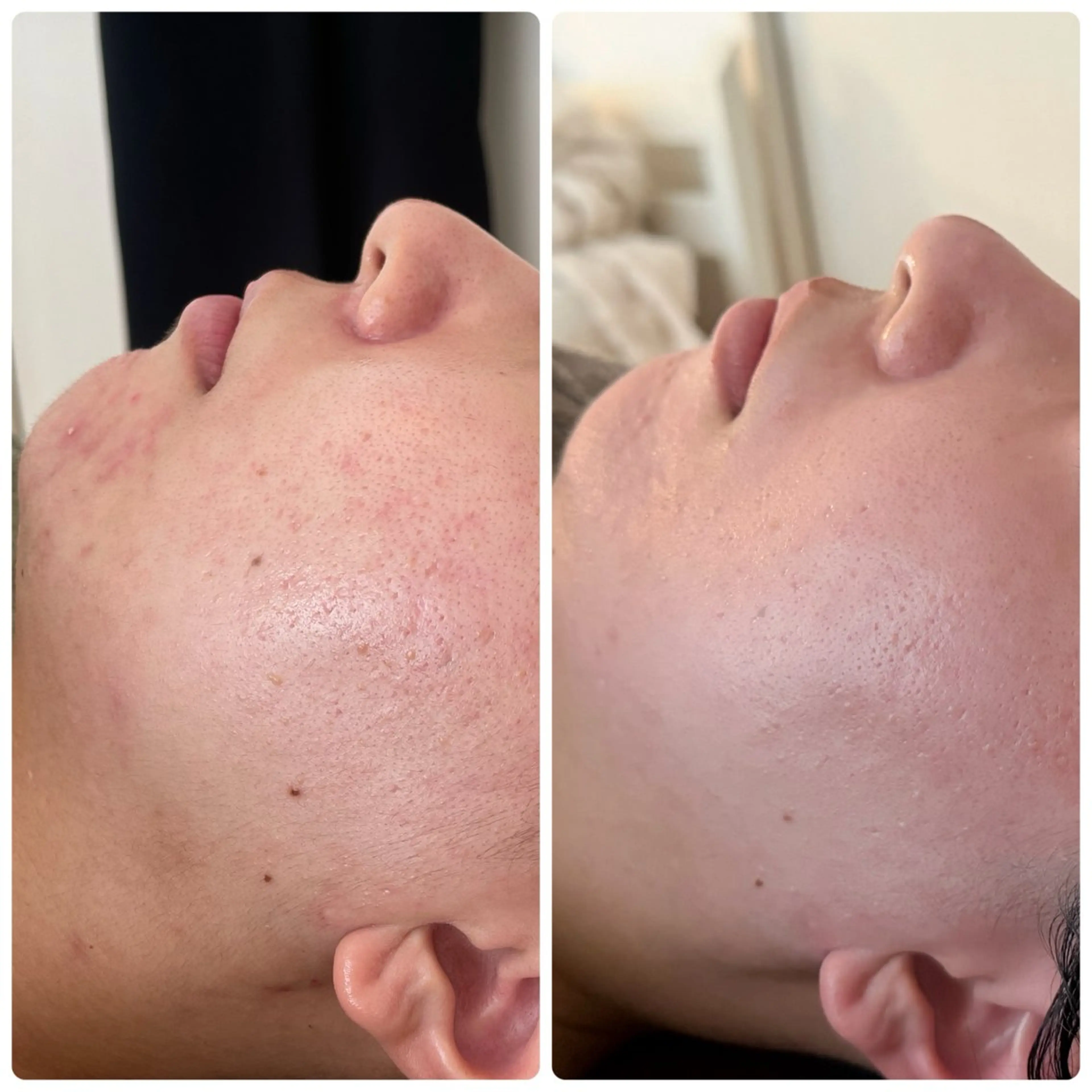 エステ ニキビ・毛穴改善 🌿ハーブピーリングのエステ・リラクイメージ