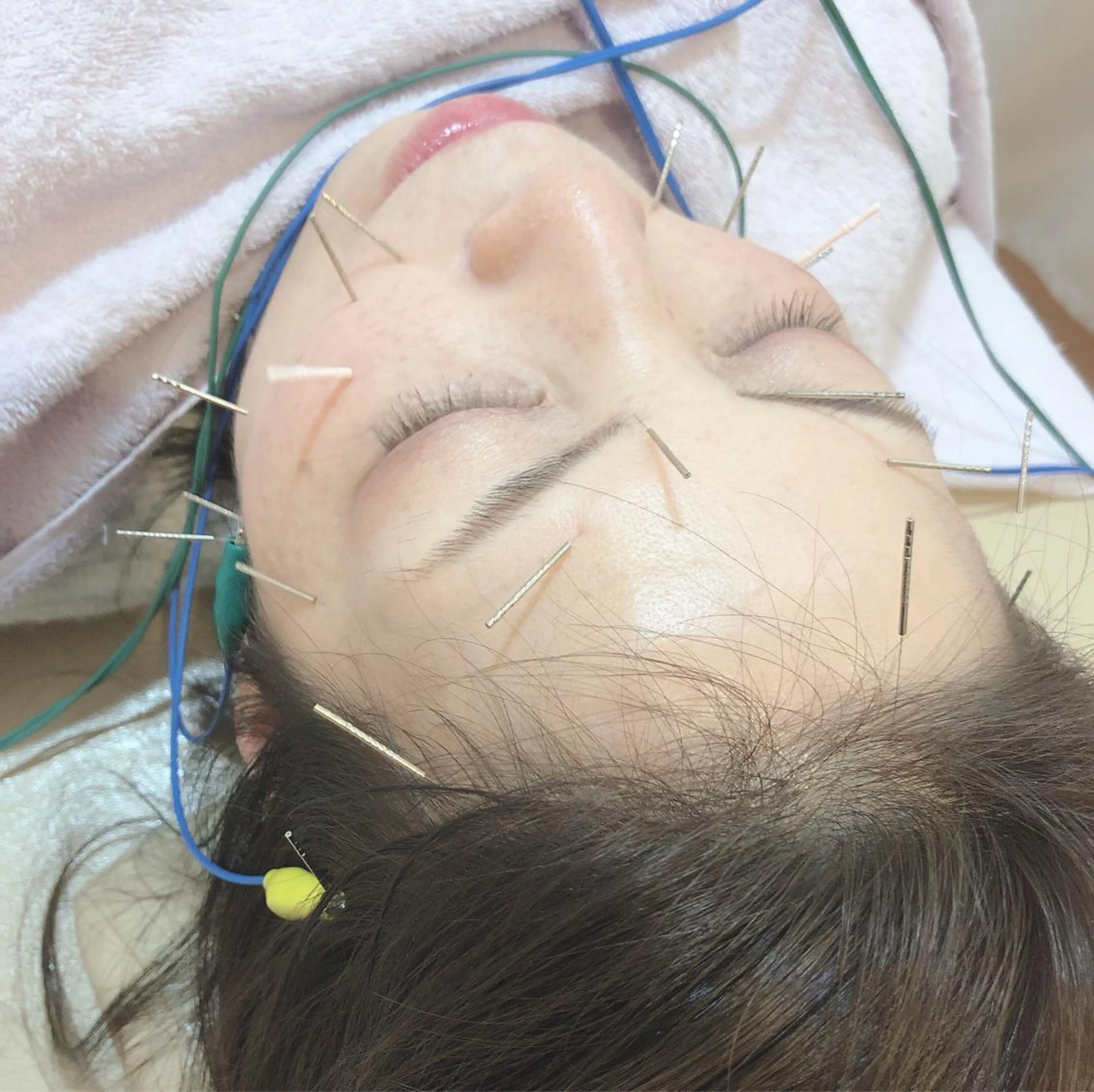 リフトアップ・たるみ ☆美容鍼小顔矯正のその他イメージ