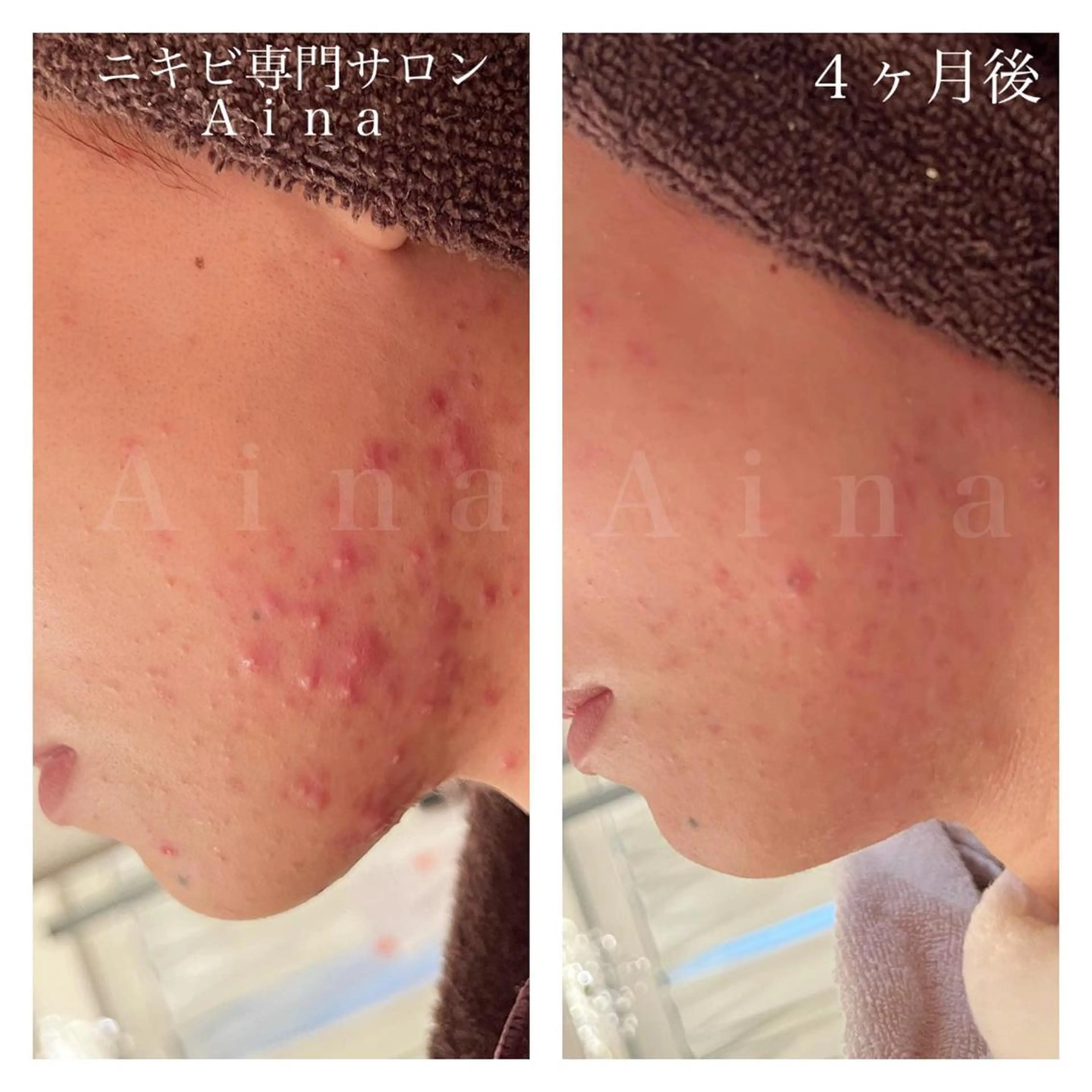 セミロング パーマ ヘアアレンジ メンズ キッズ ネイル マツエク・マツパ エステ リラク ニキビ跡専門サロン Ａｉｎａのエステ・リラクイメージ