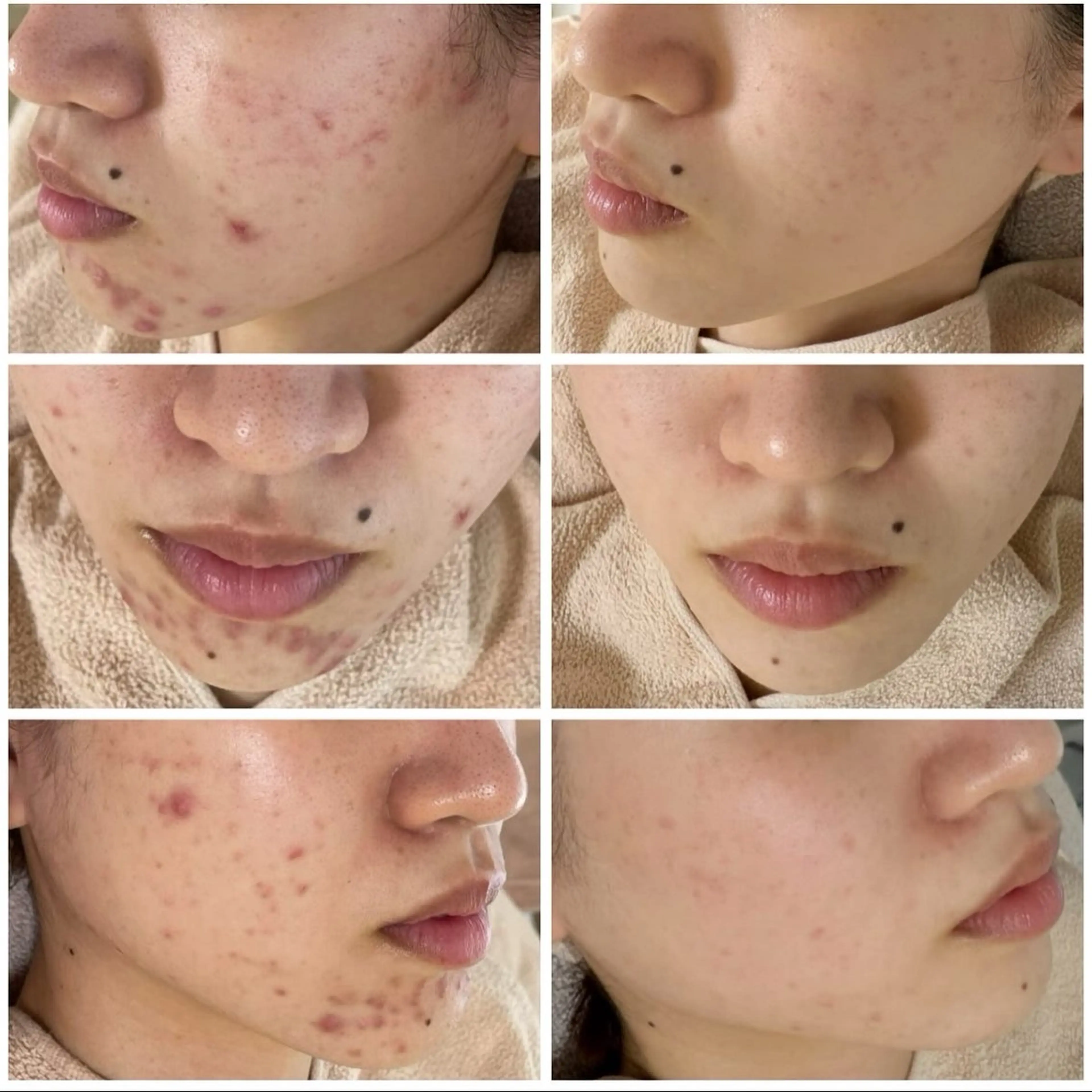 エステ ニキビ&跡改善サロン オーナー光木のエステ・リラクイメージ