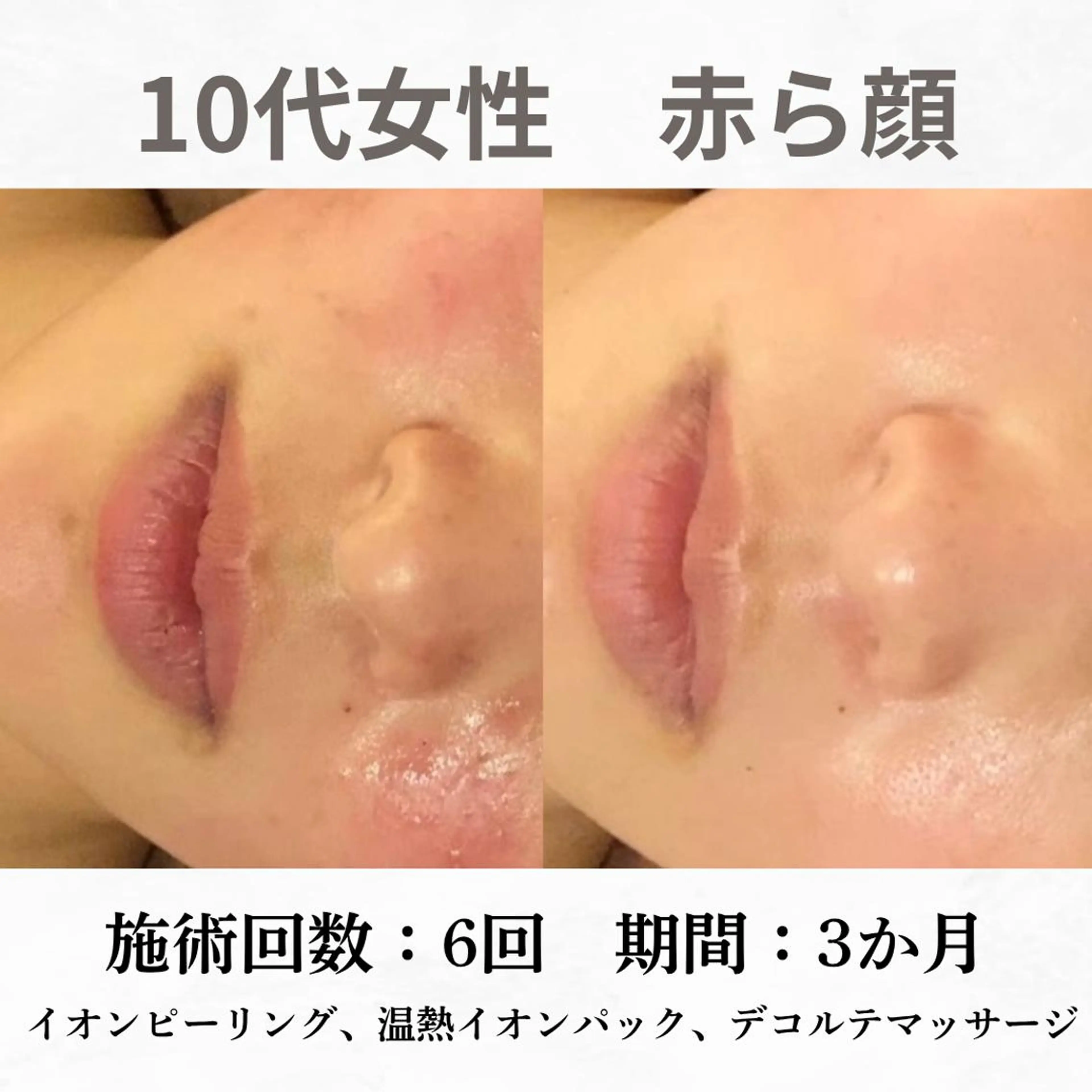 重度ニキビ専門🌷 ダウンタイムなしのエステ・リラクイメージ