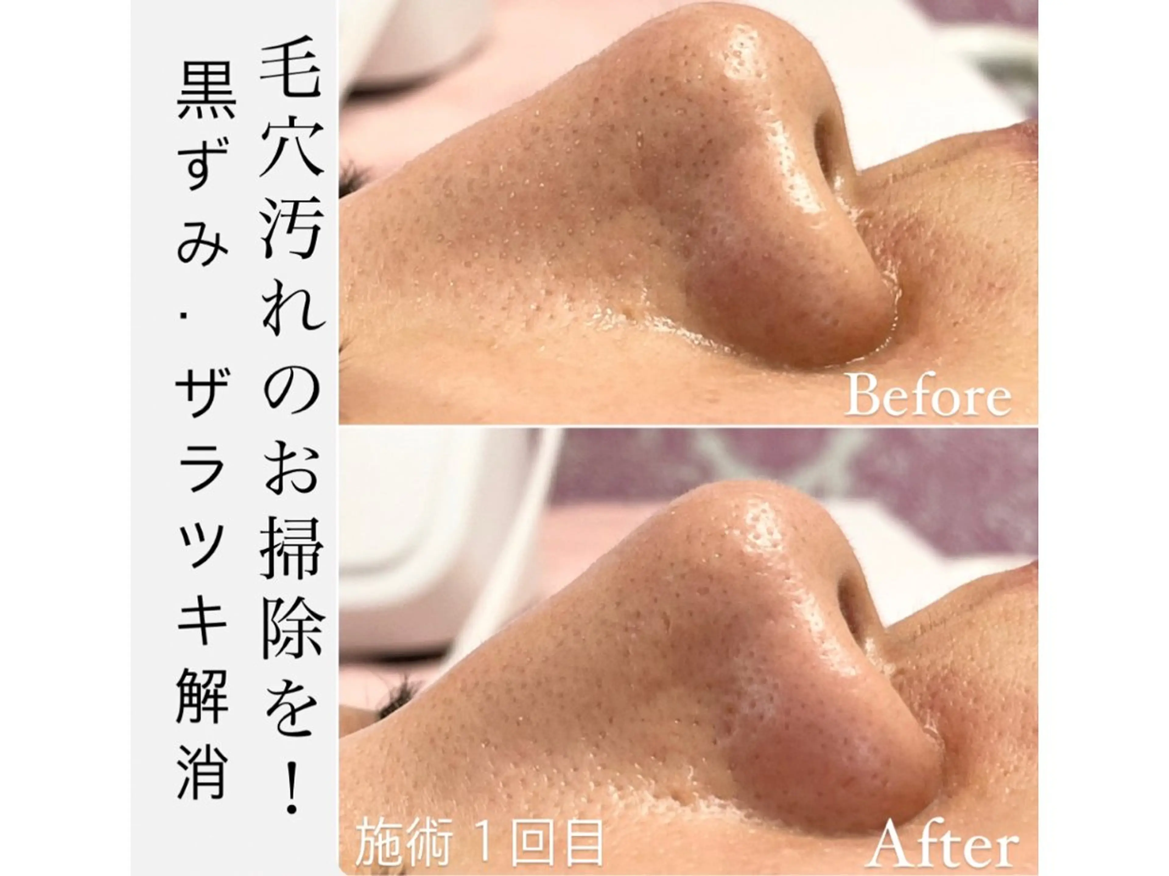 溜まってる毛穴の汚れ水素でごっそり洗浄🩵毛穴の奥まで綺麗に洗浄しモデリングパックでもっちり白玉肌にお仕上げ🙌🏻の写真