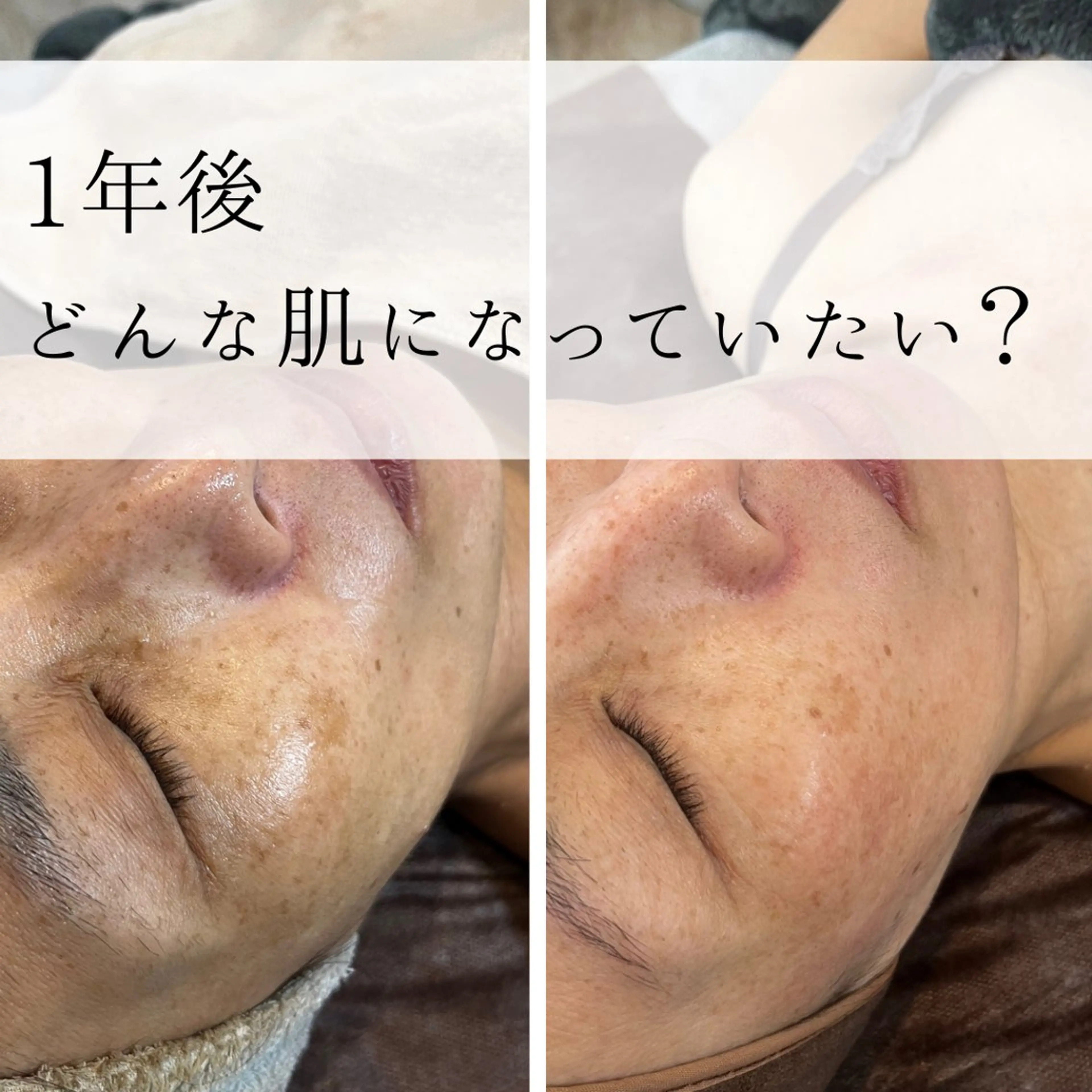 エステ yc.hacci 【ハーブピーリング】の眉毛・アイブロウイメージ