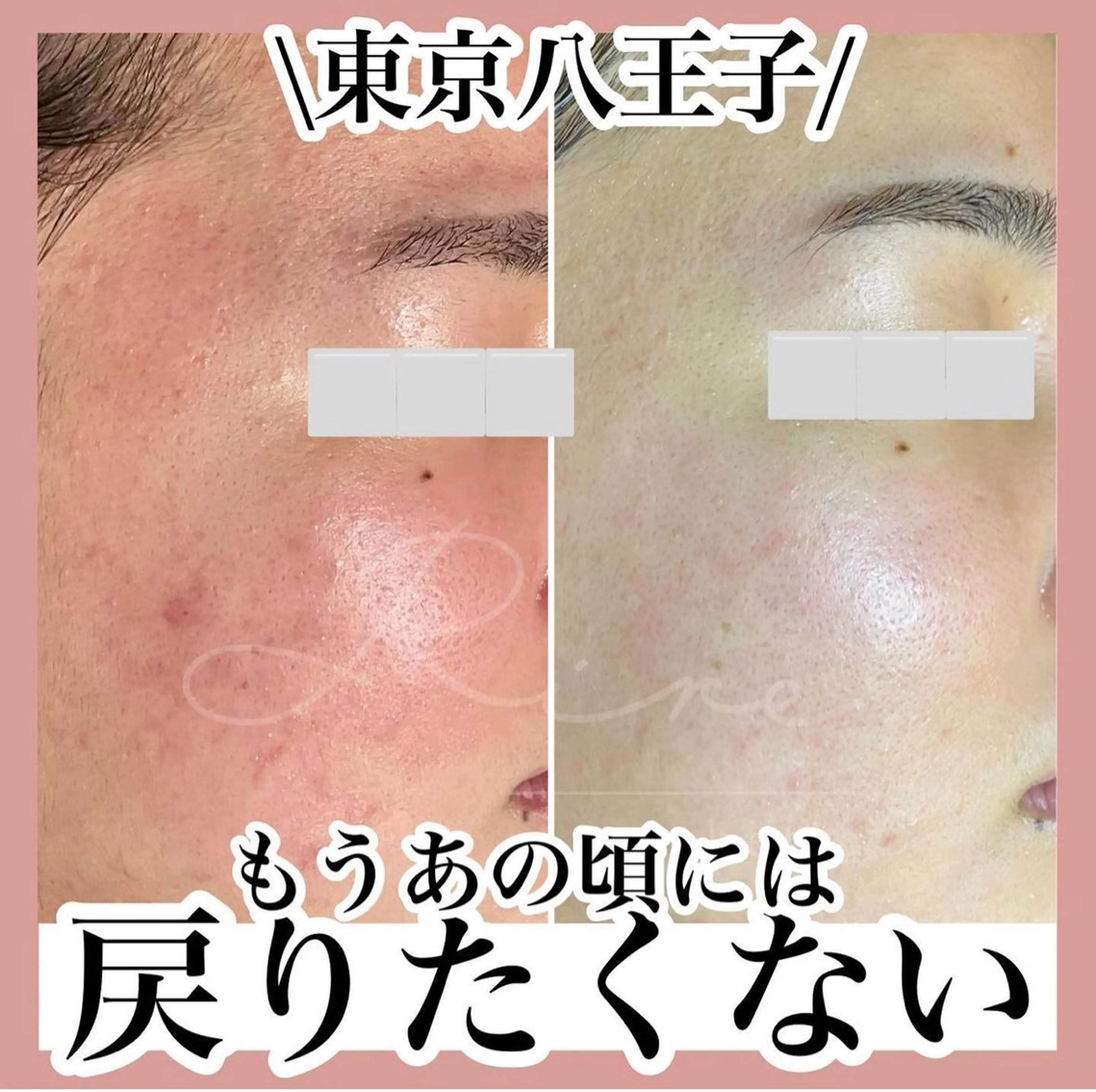 毛穴特化エステ -リールのエステ・リラクイメージ