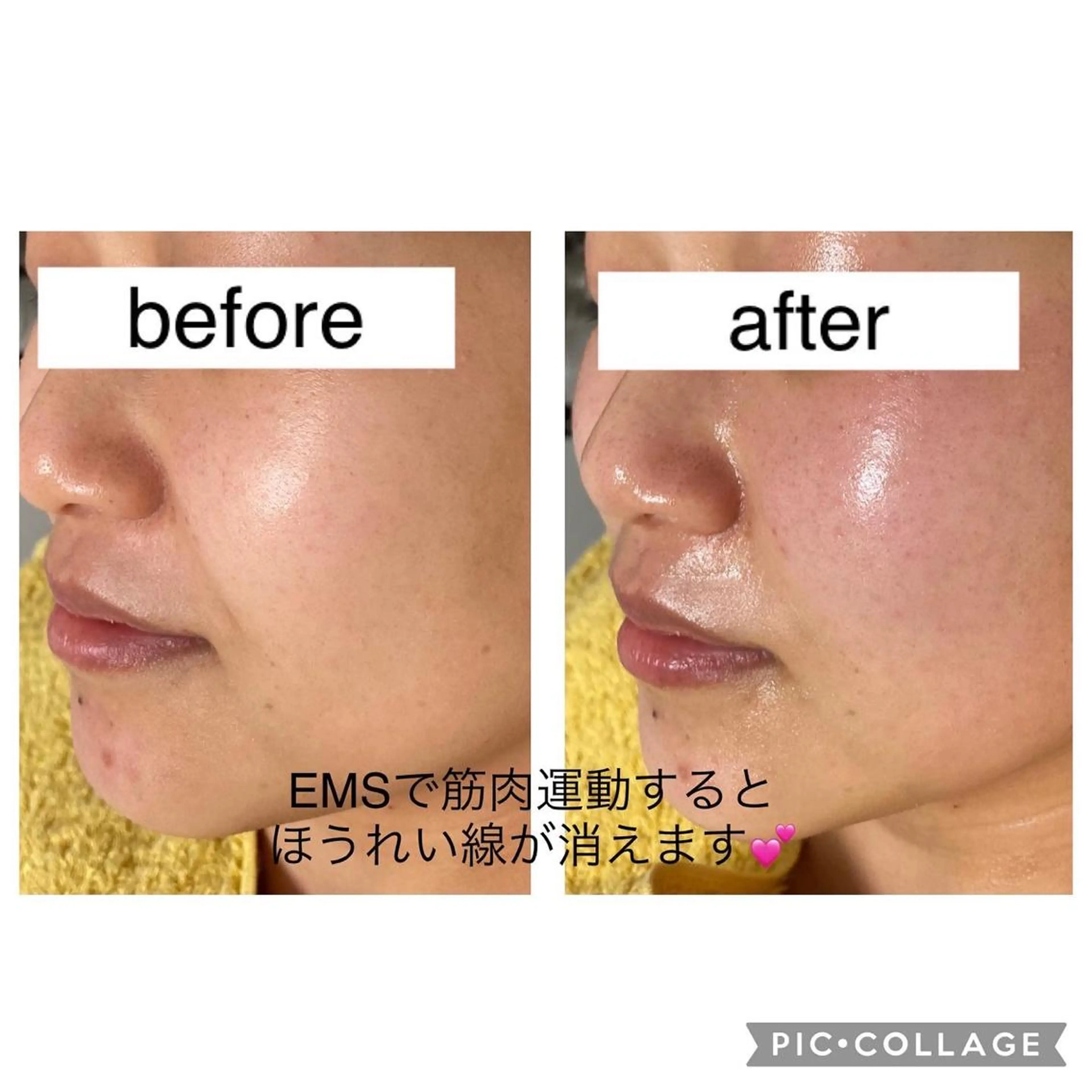 針を刺さないボトックス？！深部へ医療用電気でピュアコラーゲン&ヒアルロン酸をチューブ丸々1本導入✨の写真