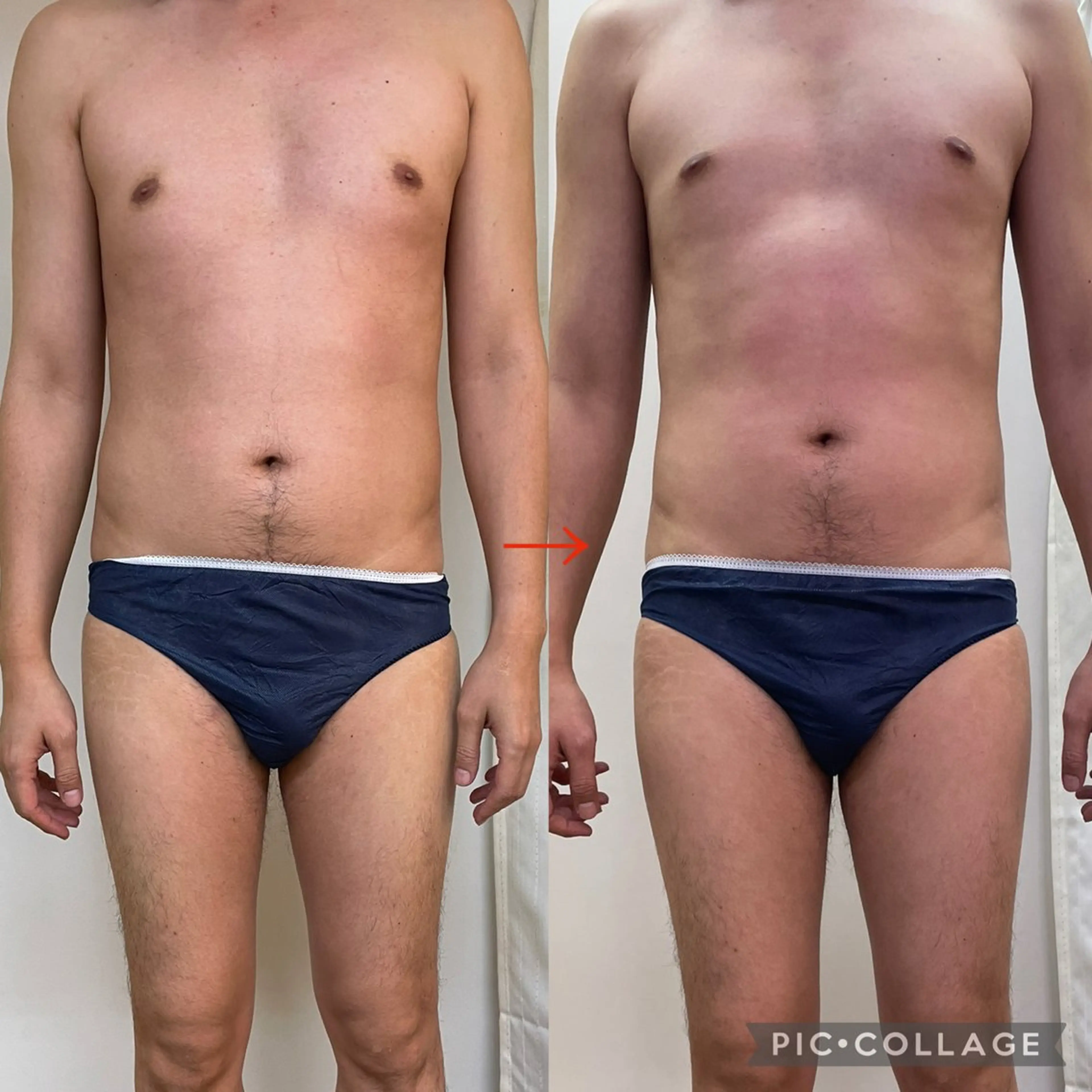 【おなかリンパ＋ハイパーナイフ＋脂肪を減らす薬剤塗布】おなかやせ30分7700円の写真