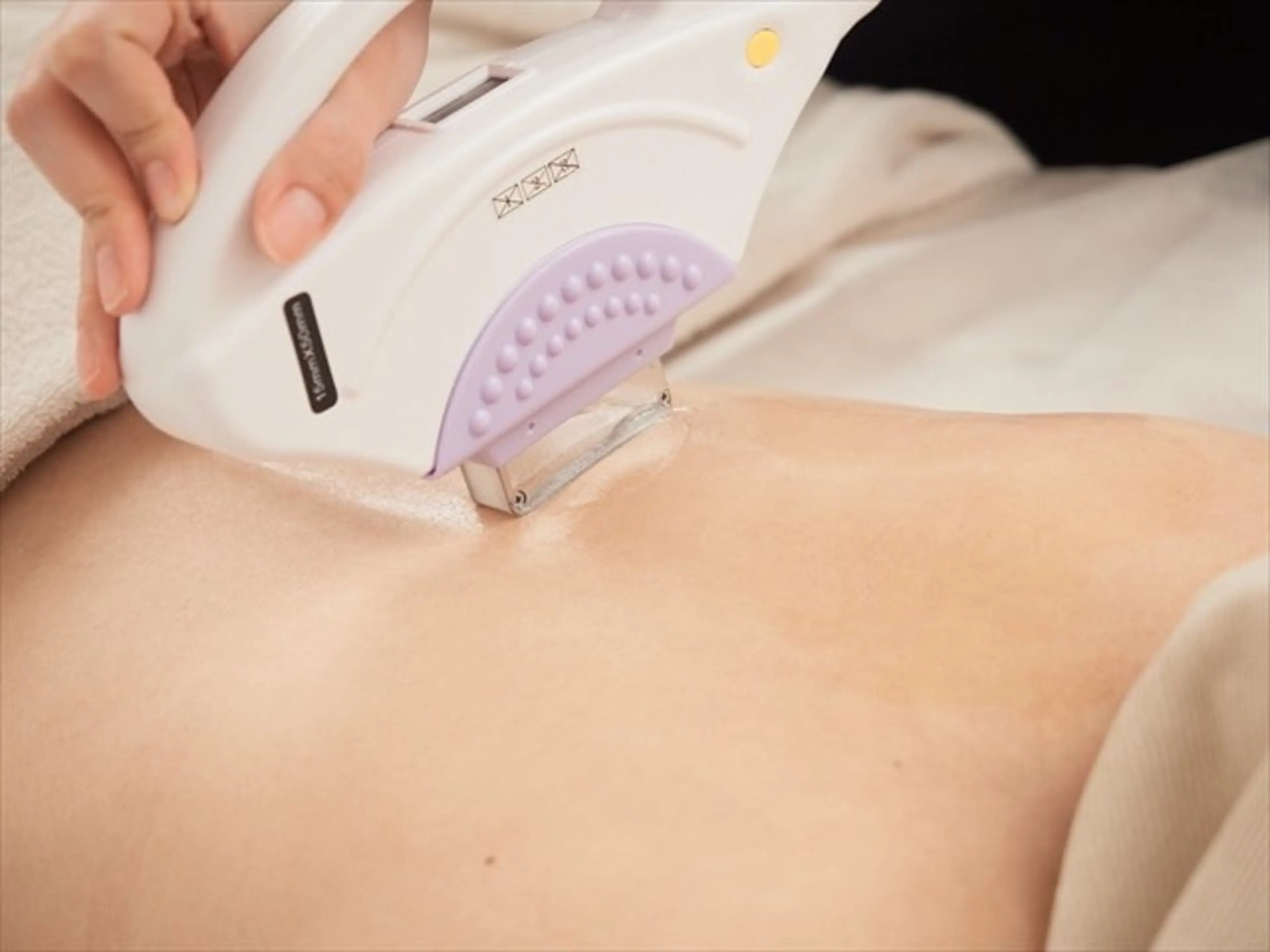 レディース　VIO脱毛の写真