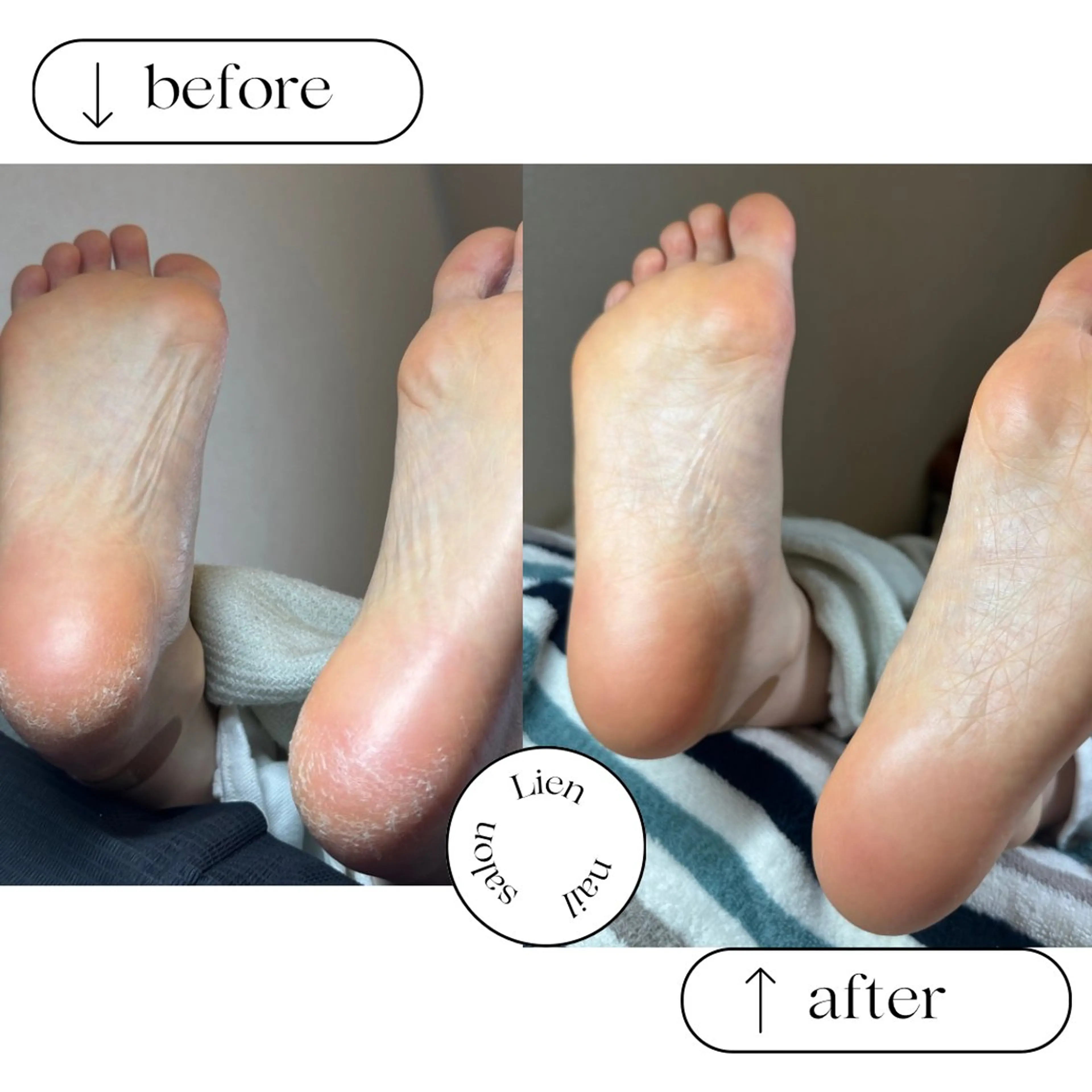 かかとの角質ツルツルケア✨newフットケアマシーンを使用してツルッツルのかかとに🩷角質除去の写真