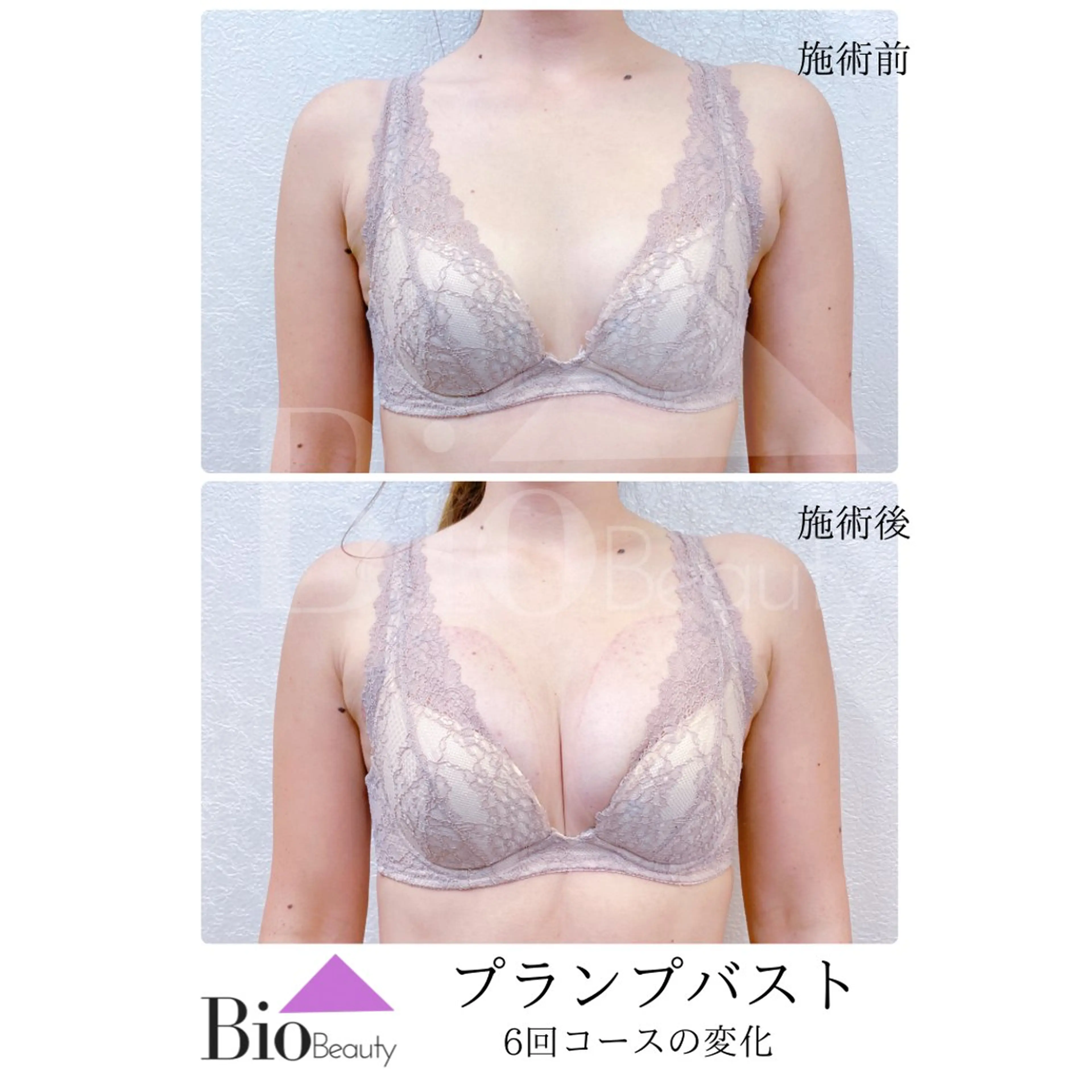 【通常価格／都度払い】プランプバスト★ふっくら綺麗なバストライン ¥58,000の写真