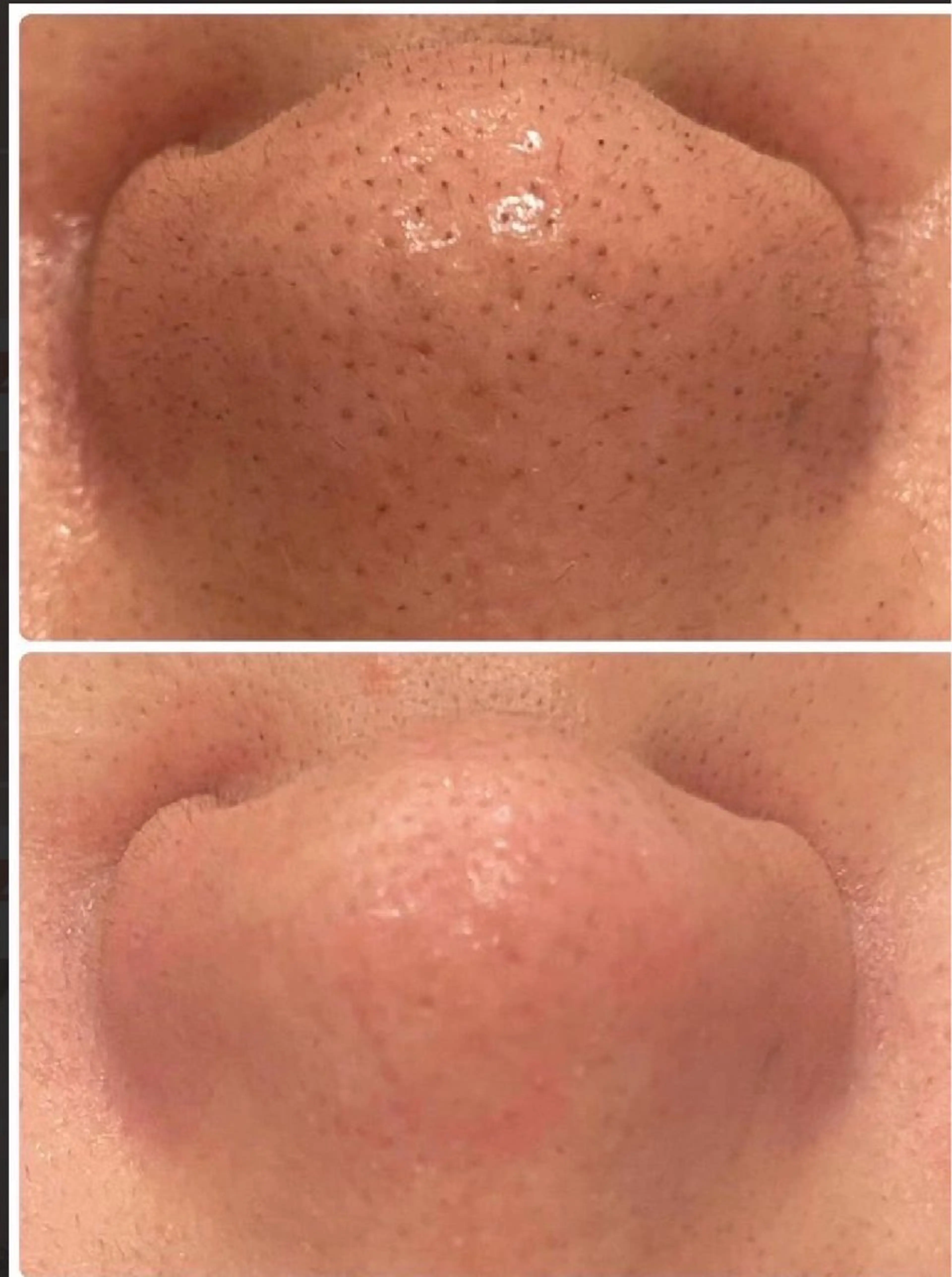 【ミニモ限定】お肌の黒ずみ・毛穴詰まり改善 ハイドラワン毛穴洗浄の写真