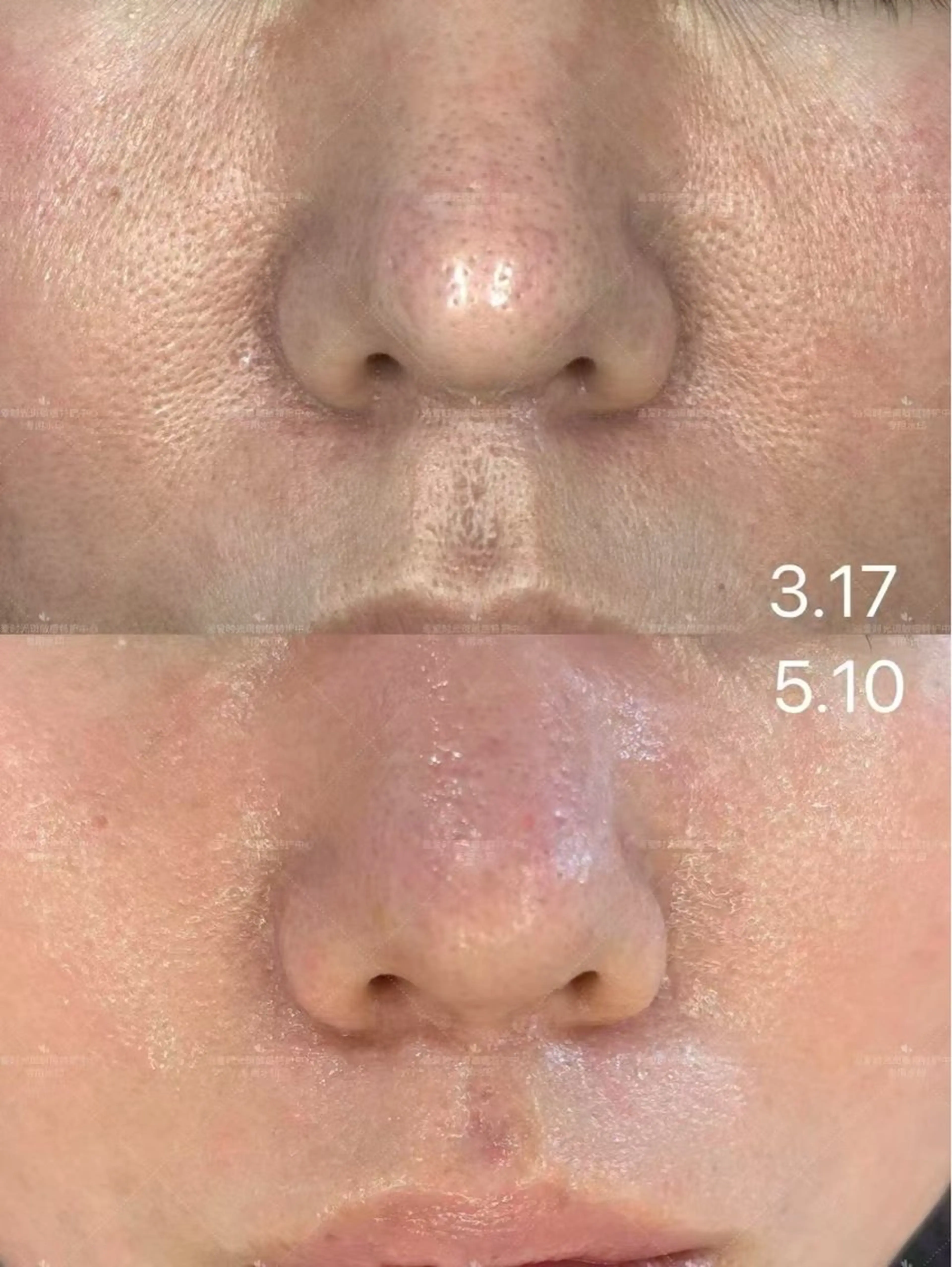 ネイル aliaハイフ&水光ジェットサロン所属・aliaハーブ水光店 エステティシャン募集のエステ・リラクイメージ