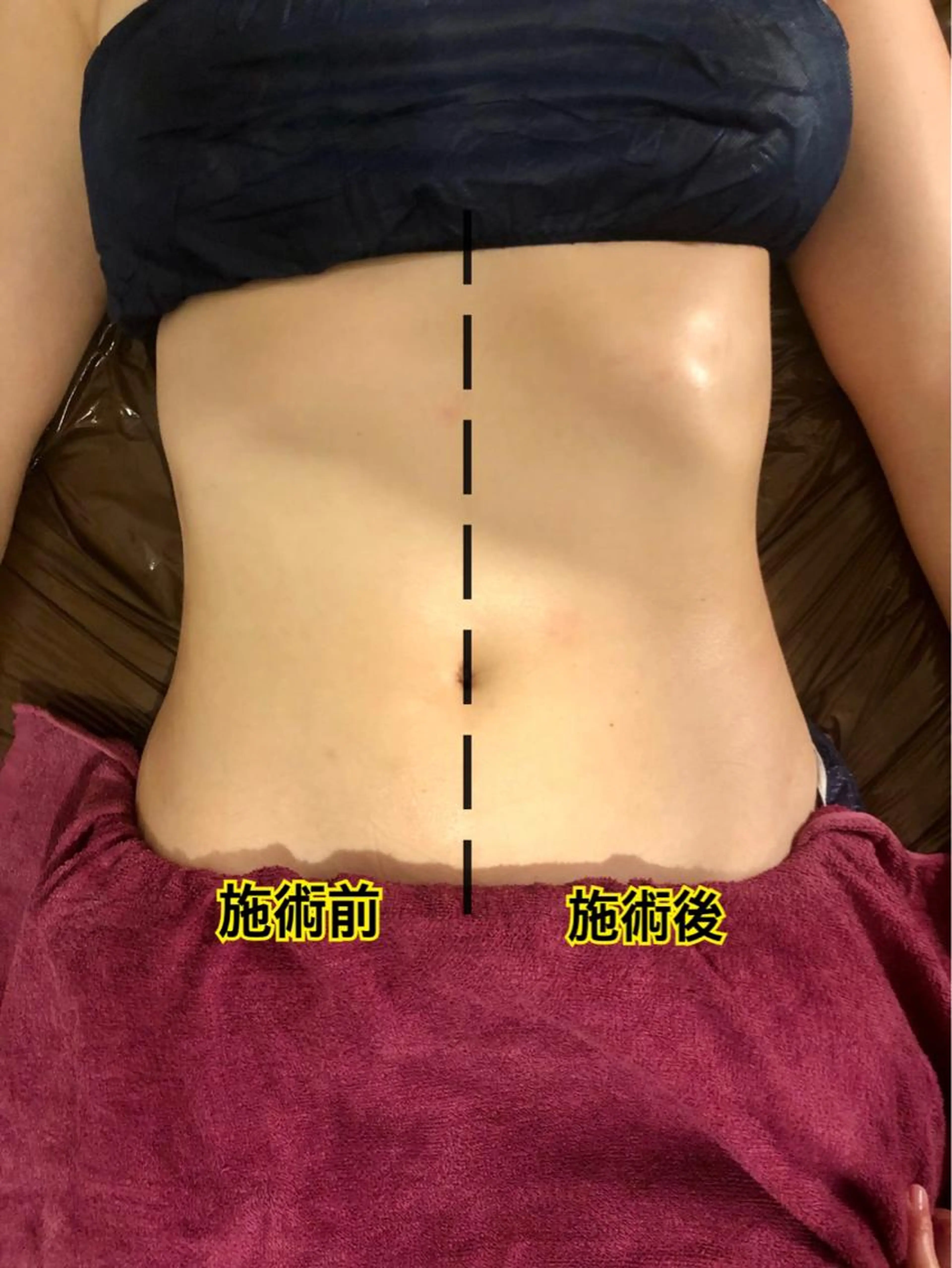 便秘解消　ぽっこりお腹　部分リリースの写真