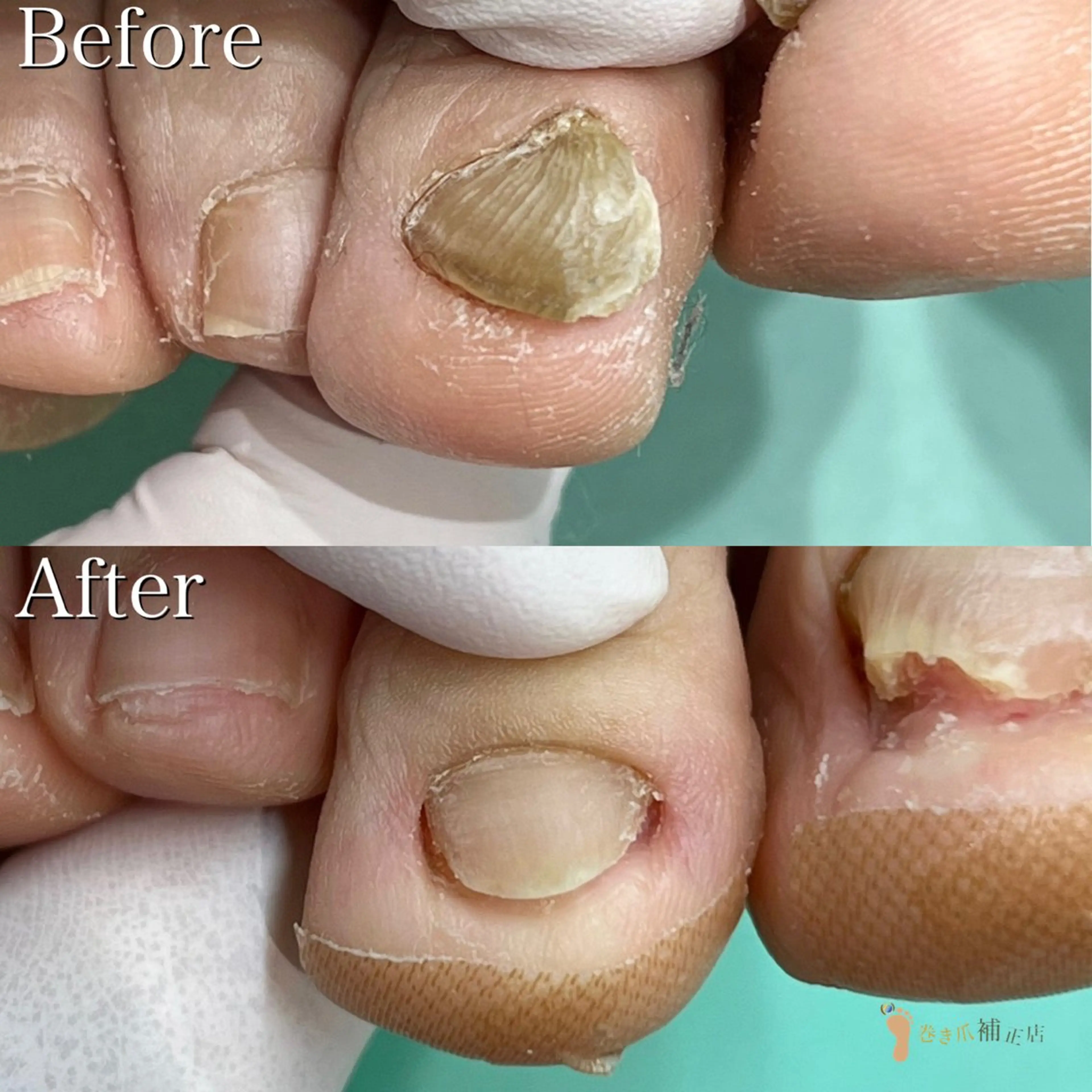 ネイル 東京巻き爪 アカデミーのエステ・リラクイメージ