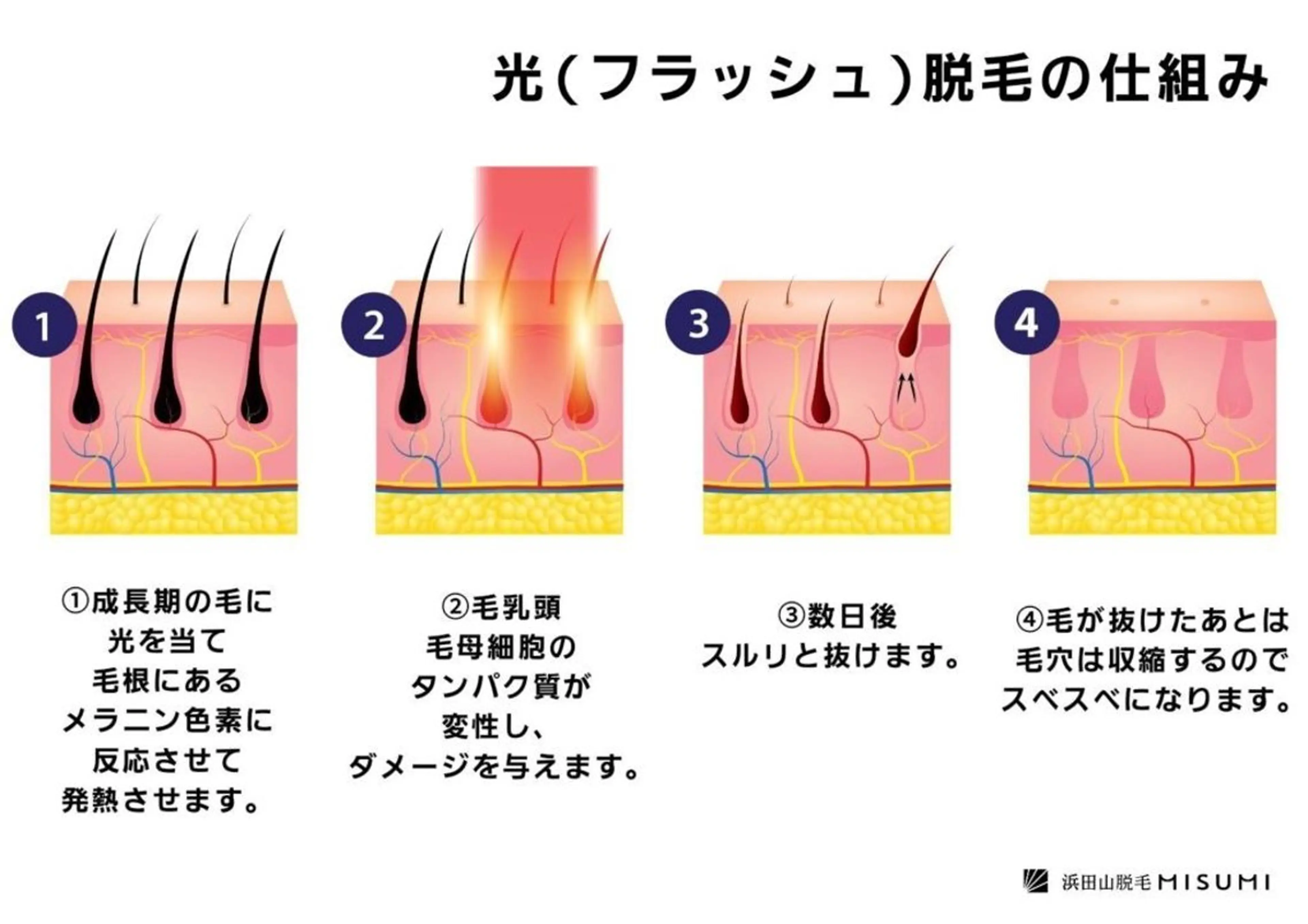 限定★レディ最新IPL高速連射脱毛機　全身脱毛　（顔&VIO込）の写真