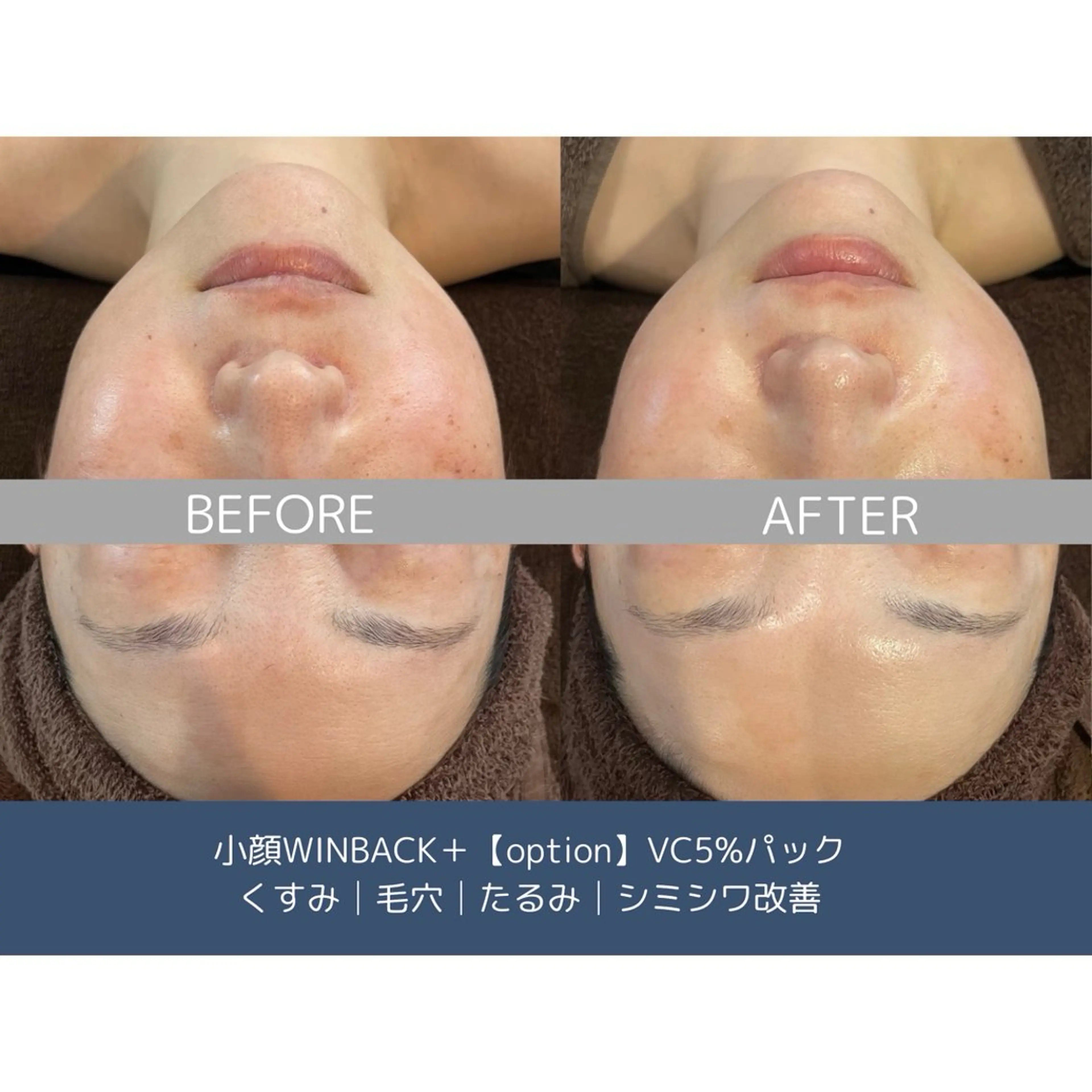 himee所属・艶肌ハーブピーリング /毛穴洗浄のエステ・リラクイメージ