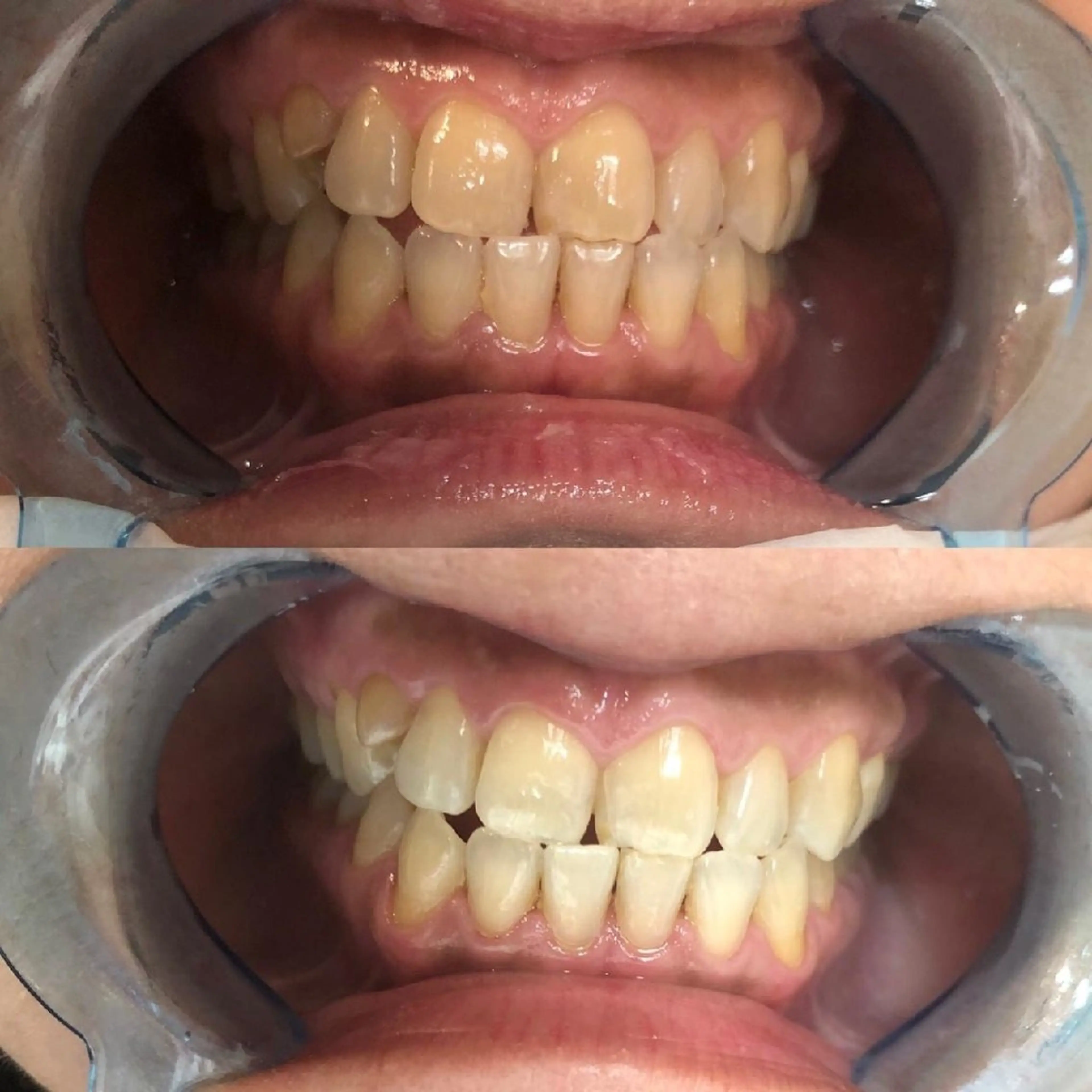 💎初回限定💎🦷ホワイトニング未経験者🦷やホワイトニングマニアの方【🌈30分照射￥9900➡️￥2980円🌈】の写真