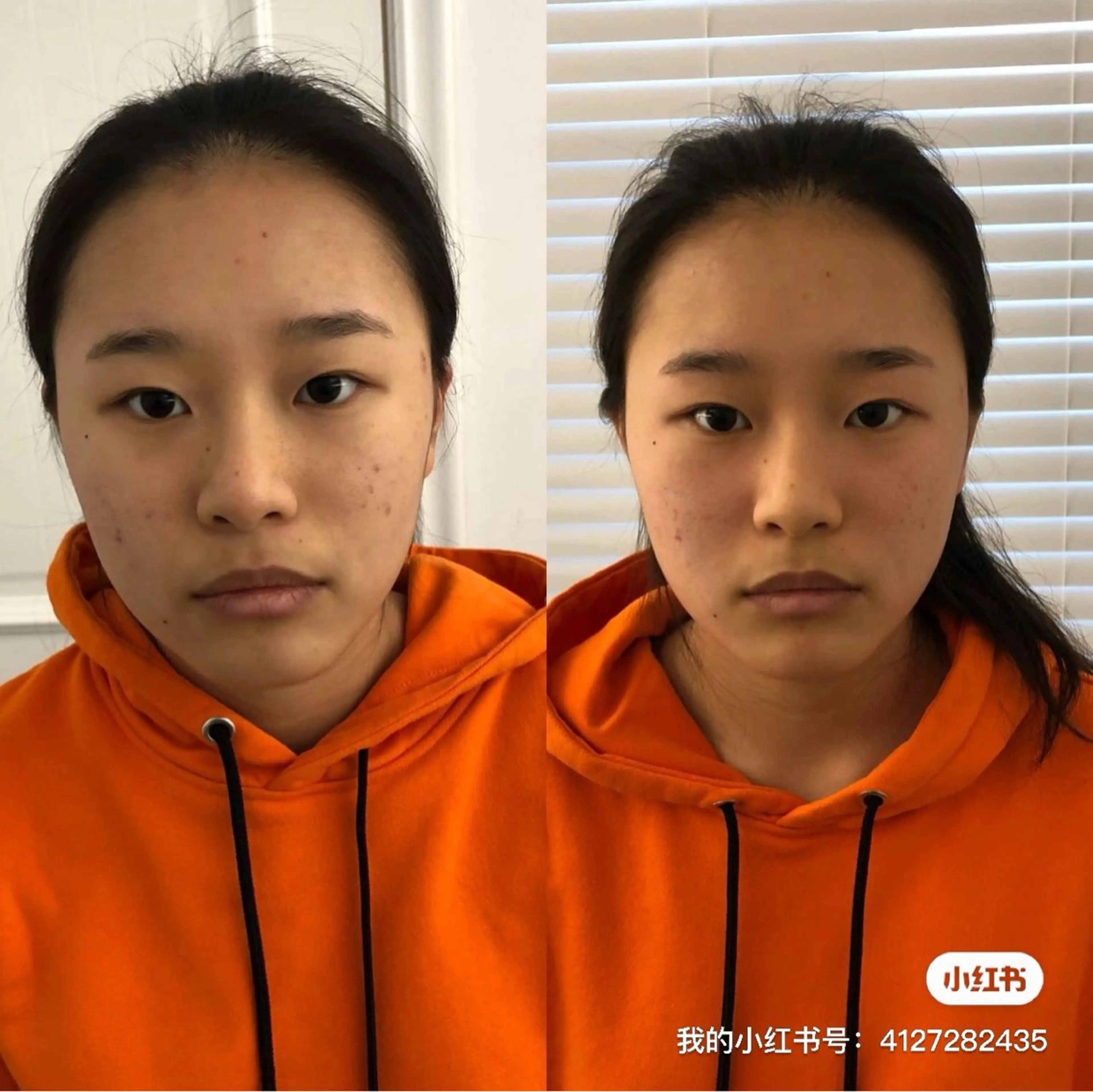 人気No.1】全顔小顔矯正（コルギ）¥13880の写真