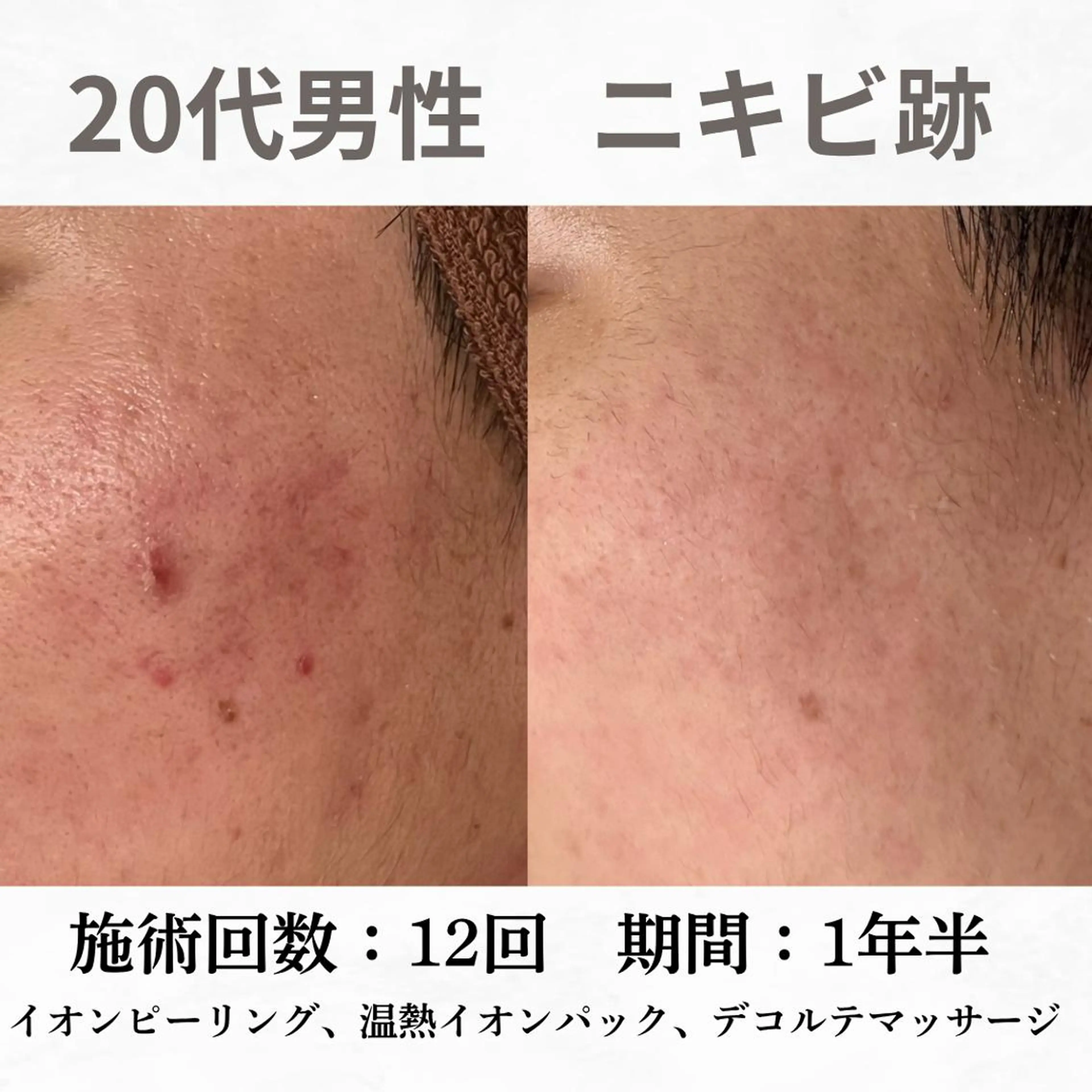 重度ニキビ専門🌷 ダウンタイムなしのエステ・リラクイメージ