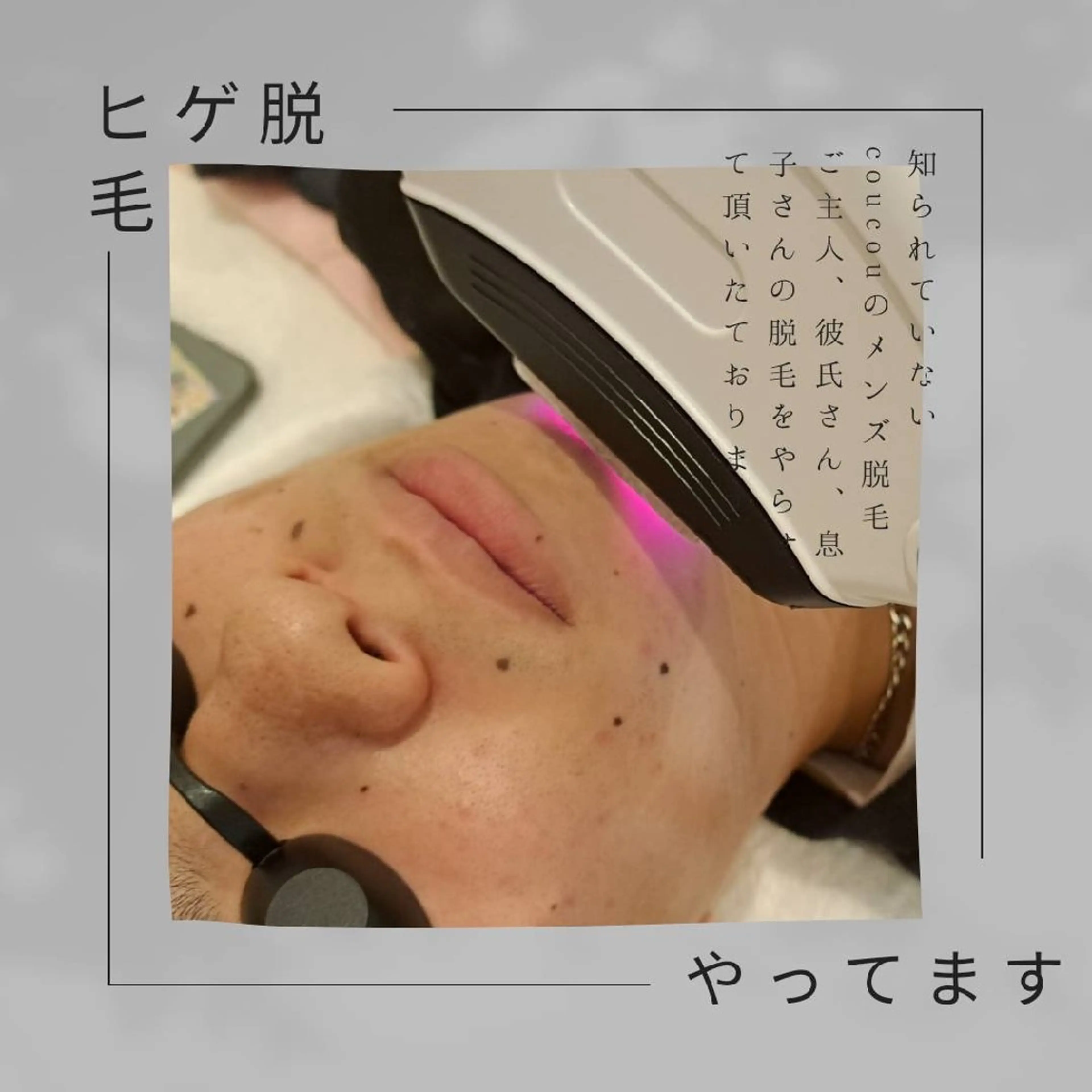 メンズ men'sひげ脱毛【ミニモ限定メニュー】の写真