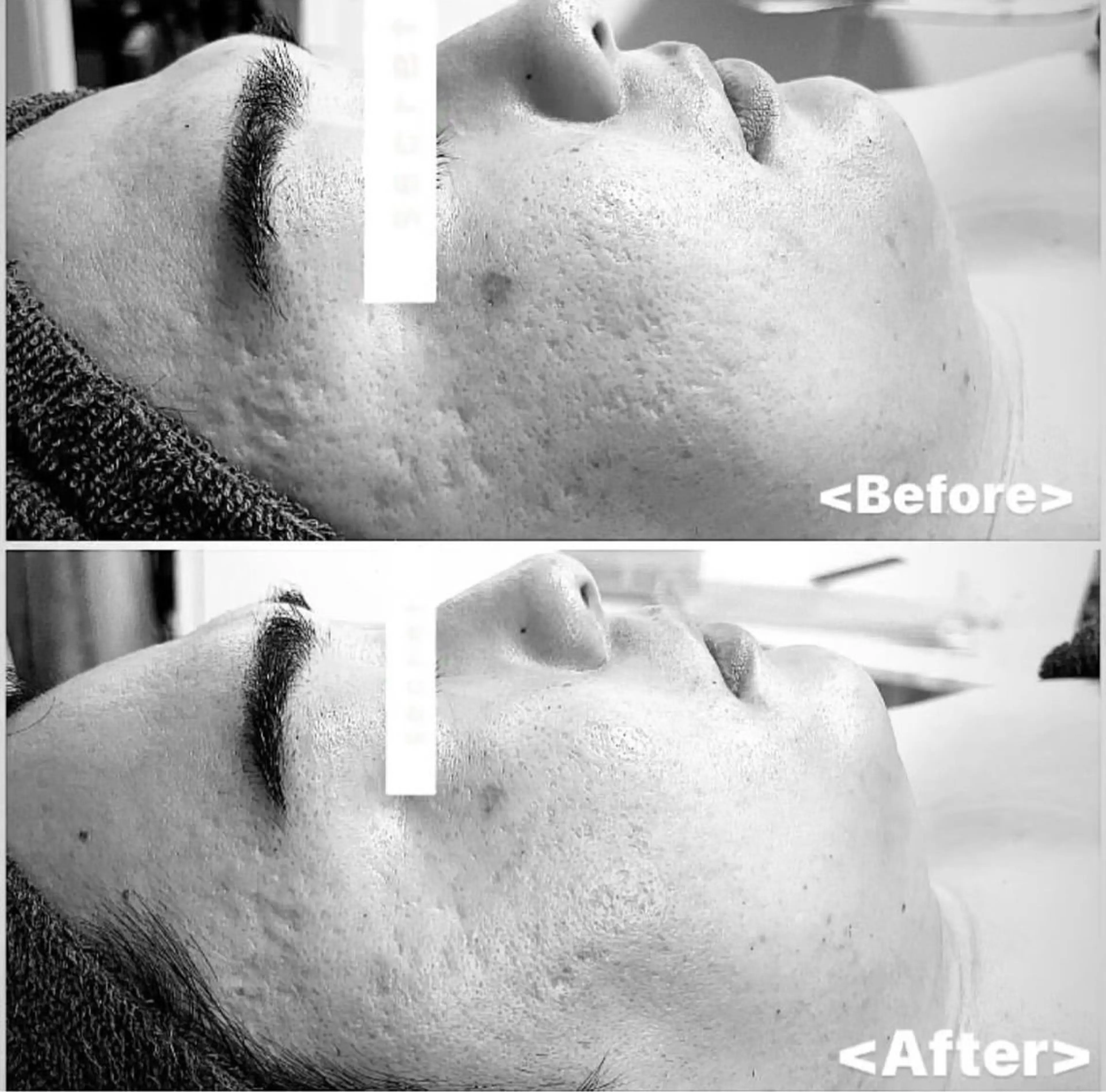 REVIハーブピーリング🌿【長年のニキビやクレーター肌でお悩みの方・気になる方へ】の写真