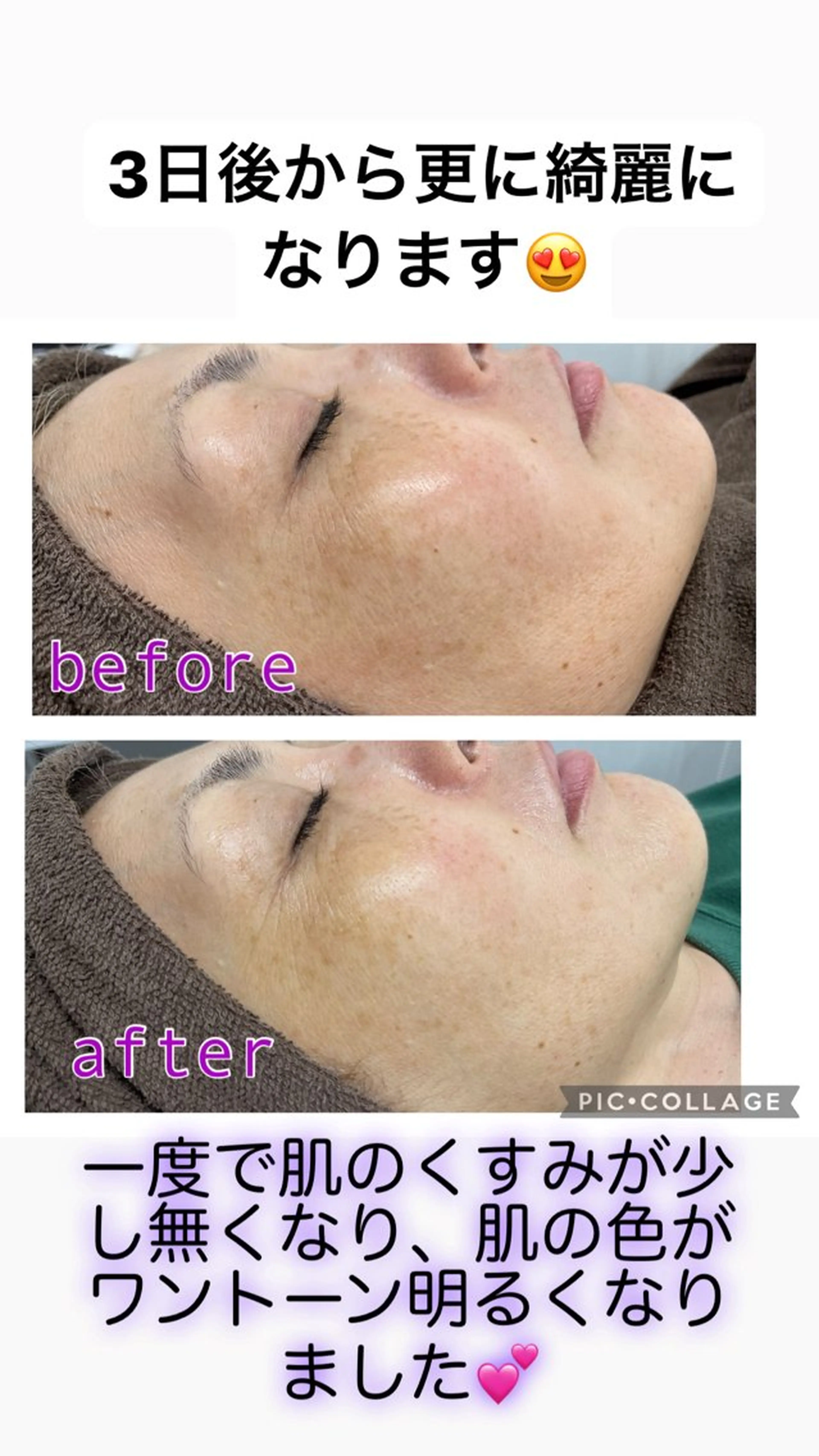 短期集中💕🌿肌質改善3回コースの写真