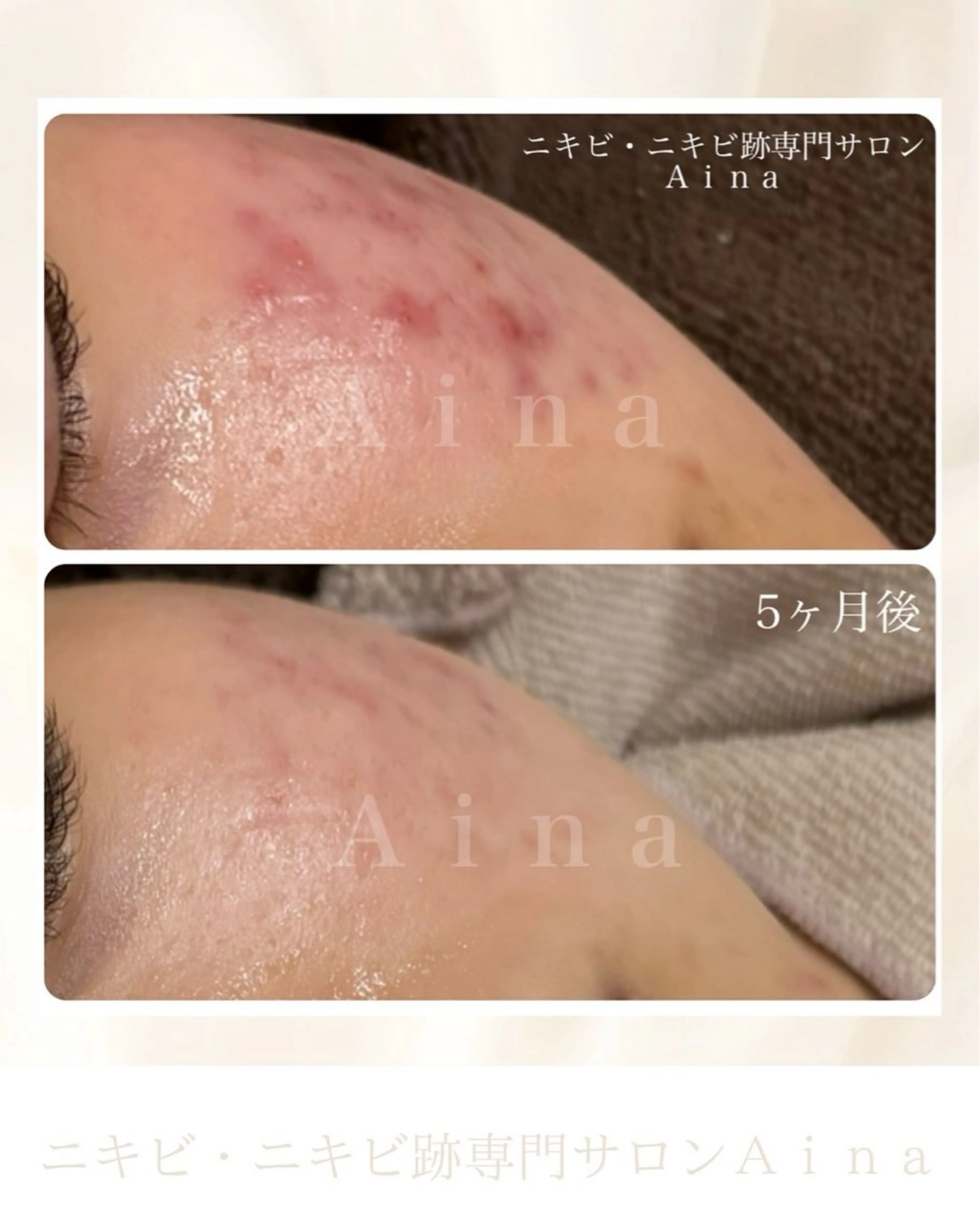 エステ リラク ニキビ跡専門サロン Ａｉｎａのエステ・リラクイメージ