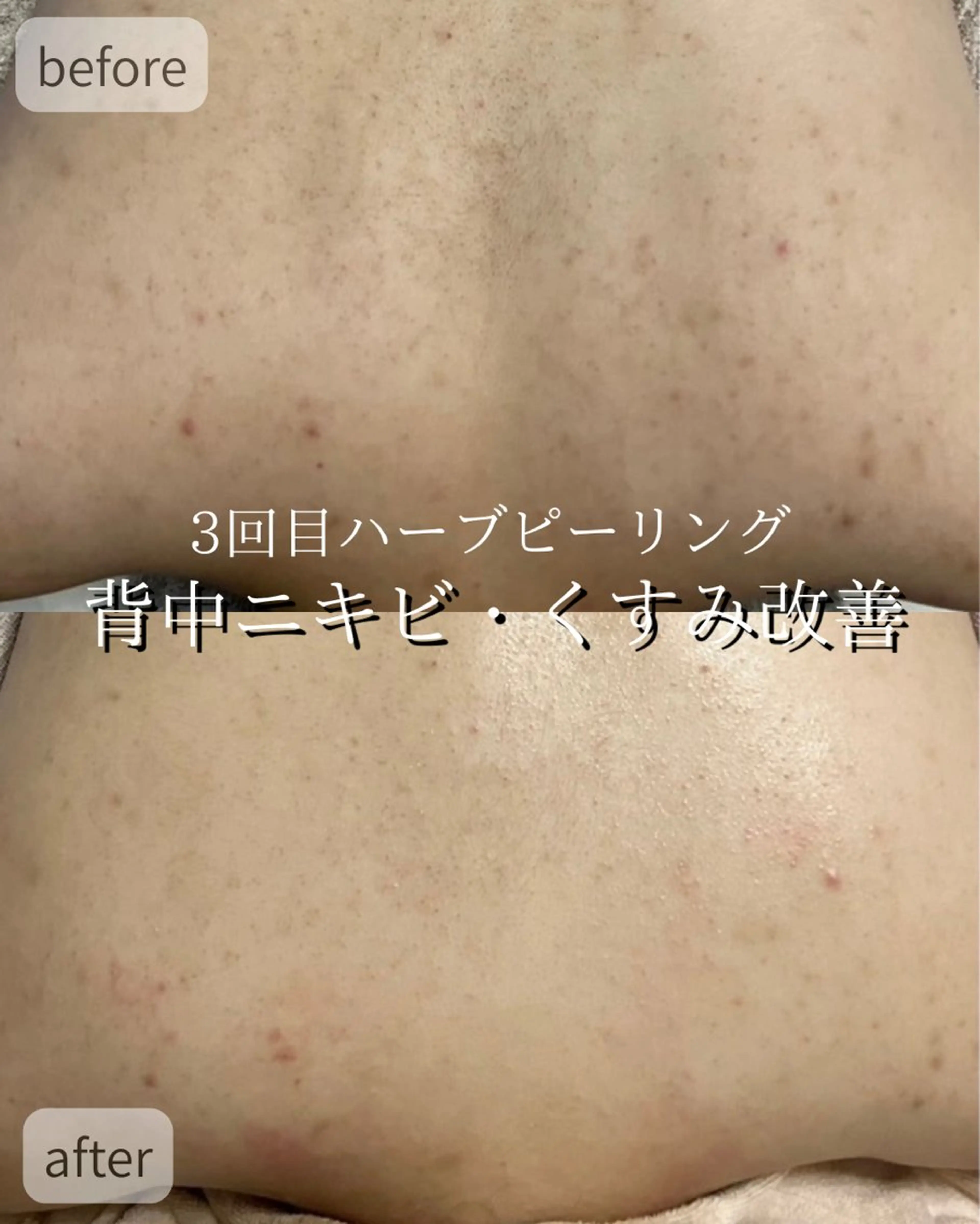 【夏までに背中美人に！】背中全体ハーブピーリング🌿剥離なし・ダウンタイムなしの写真