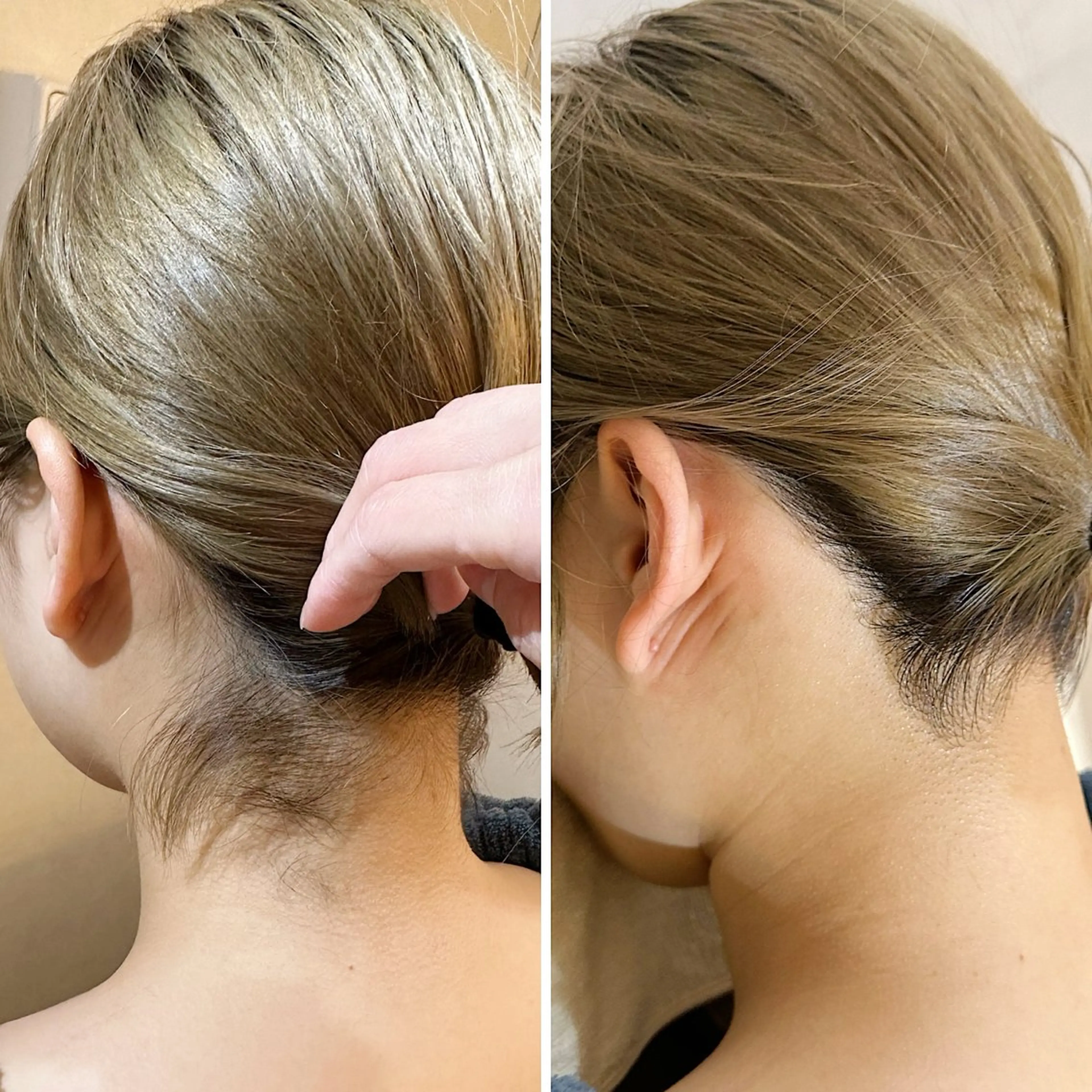 脱毛 うなじ脱毛/美肌脱毛 LABELのエステ・リラクイメージ