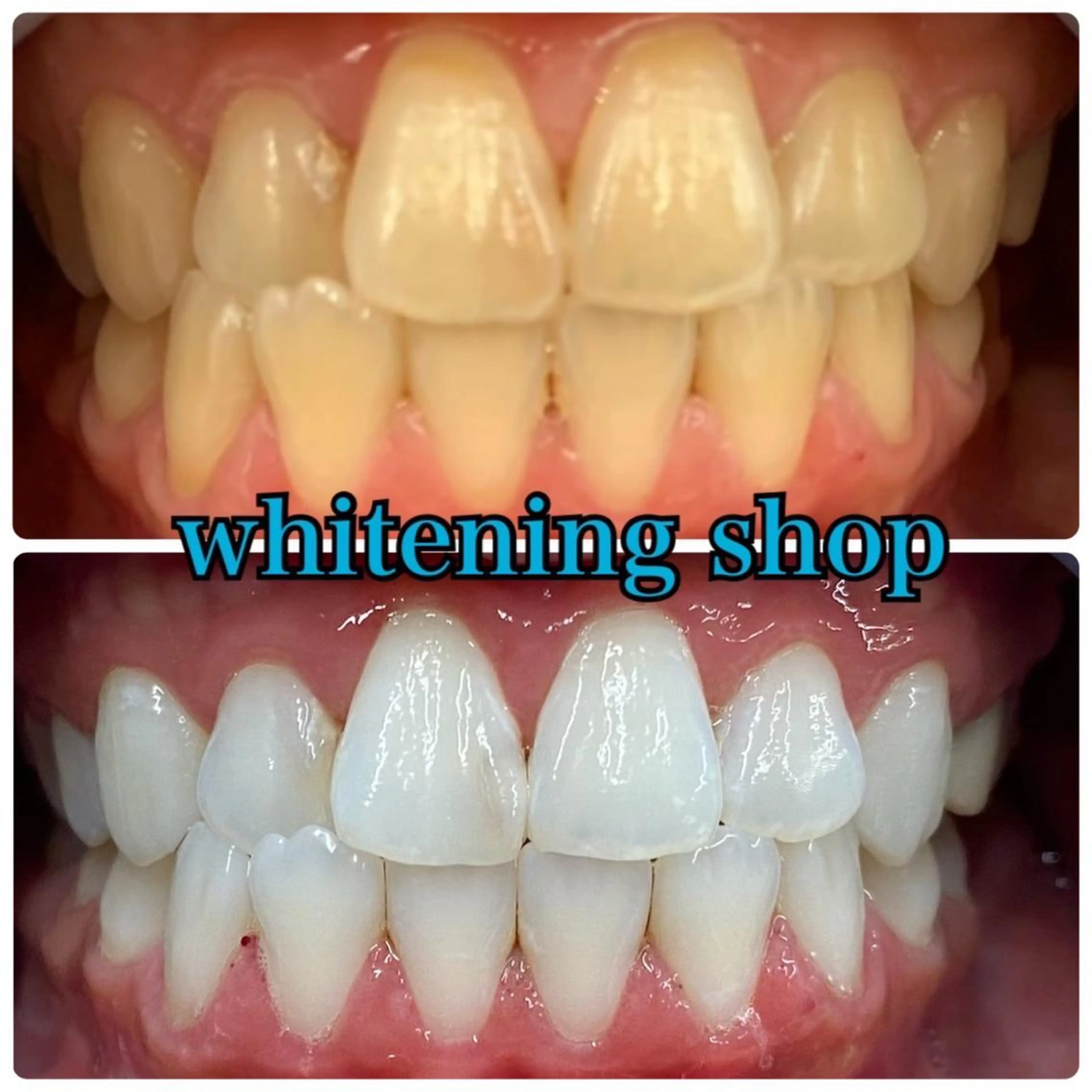 💎minimo特別キャンペーン💎 【20分×2回】お試しホワイトニング🦷✨の写真