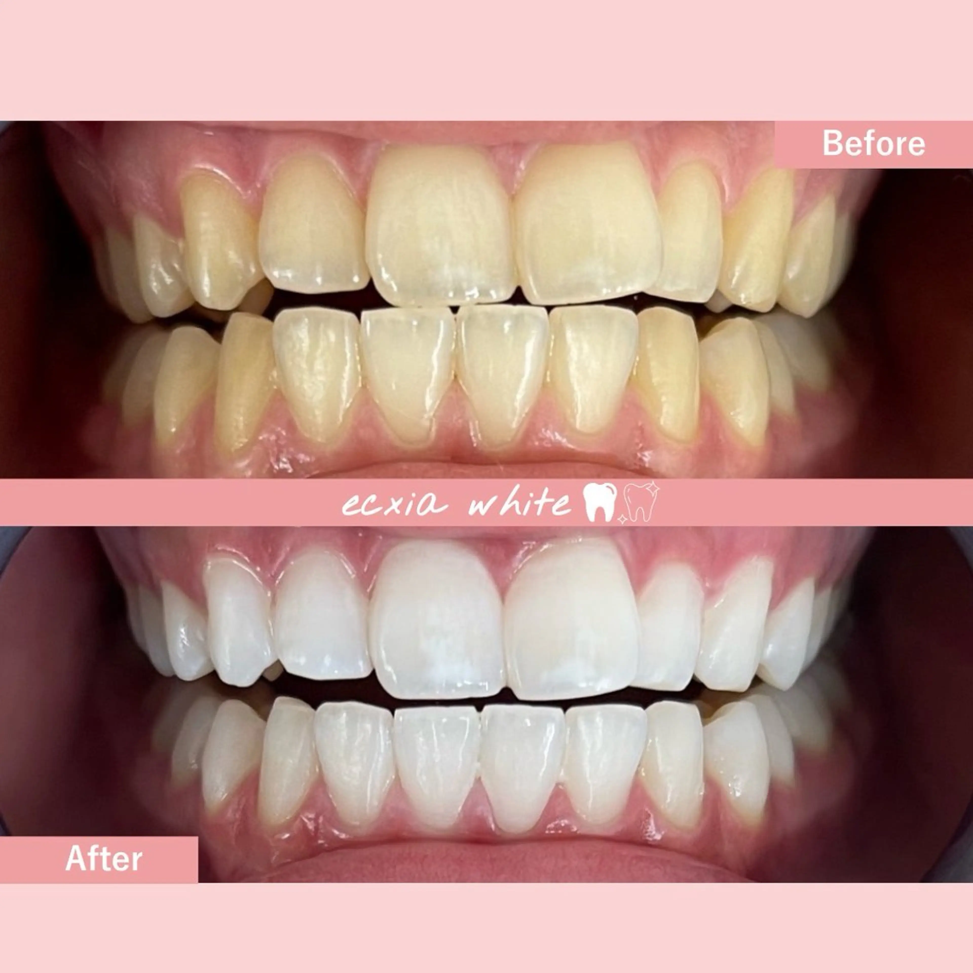 【医療提携ジェル付】5​〜​6トーンUP◎ハイパワーホワイトニング30分照射［札幌/西区/琴似/ホワイトニング］の写真